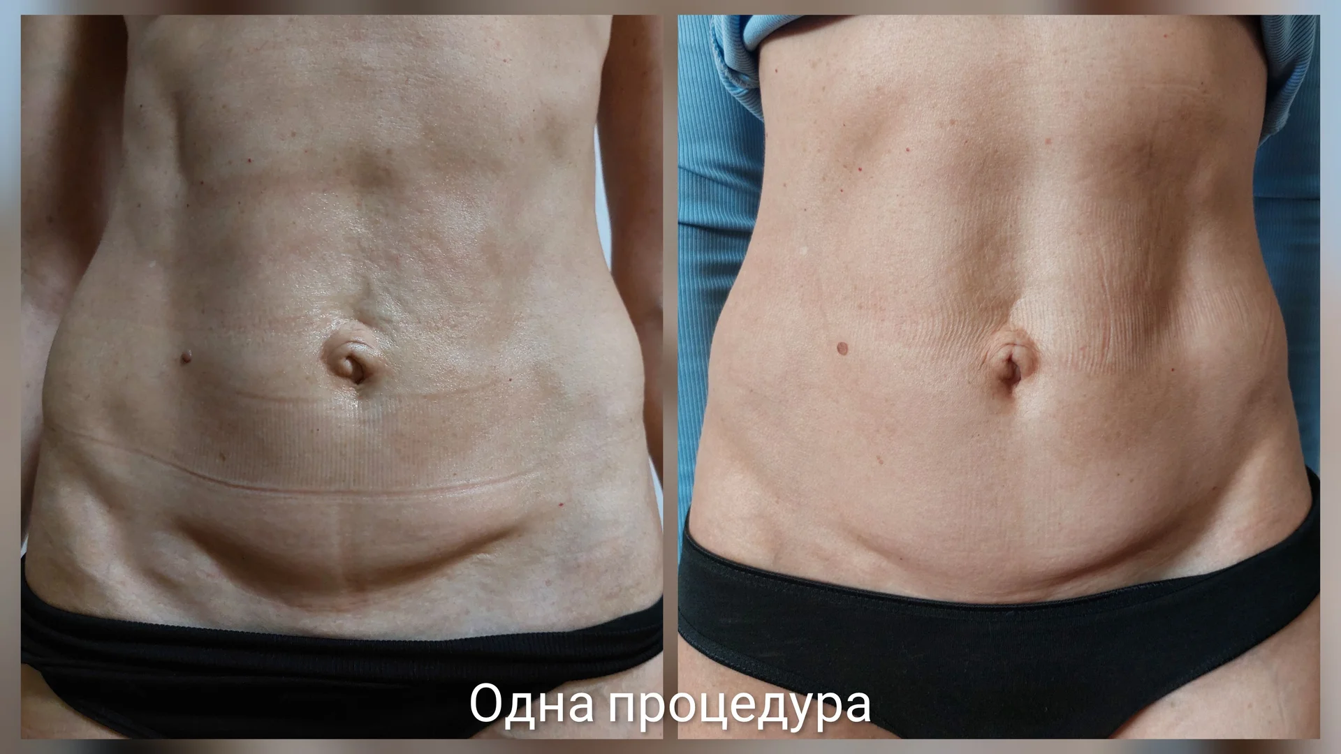 Здоровое омоложение Холодной плазмой - миниатюра 5