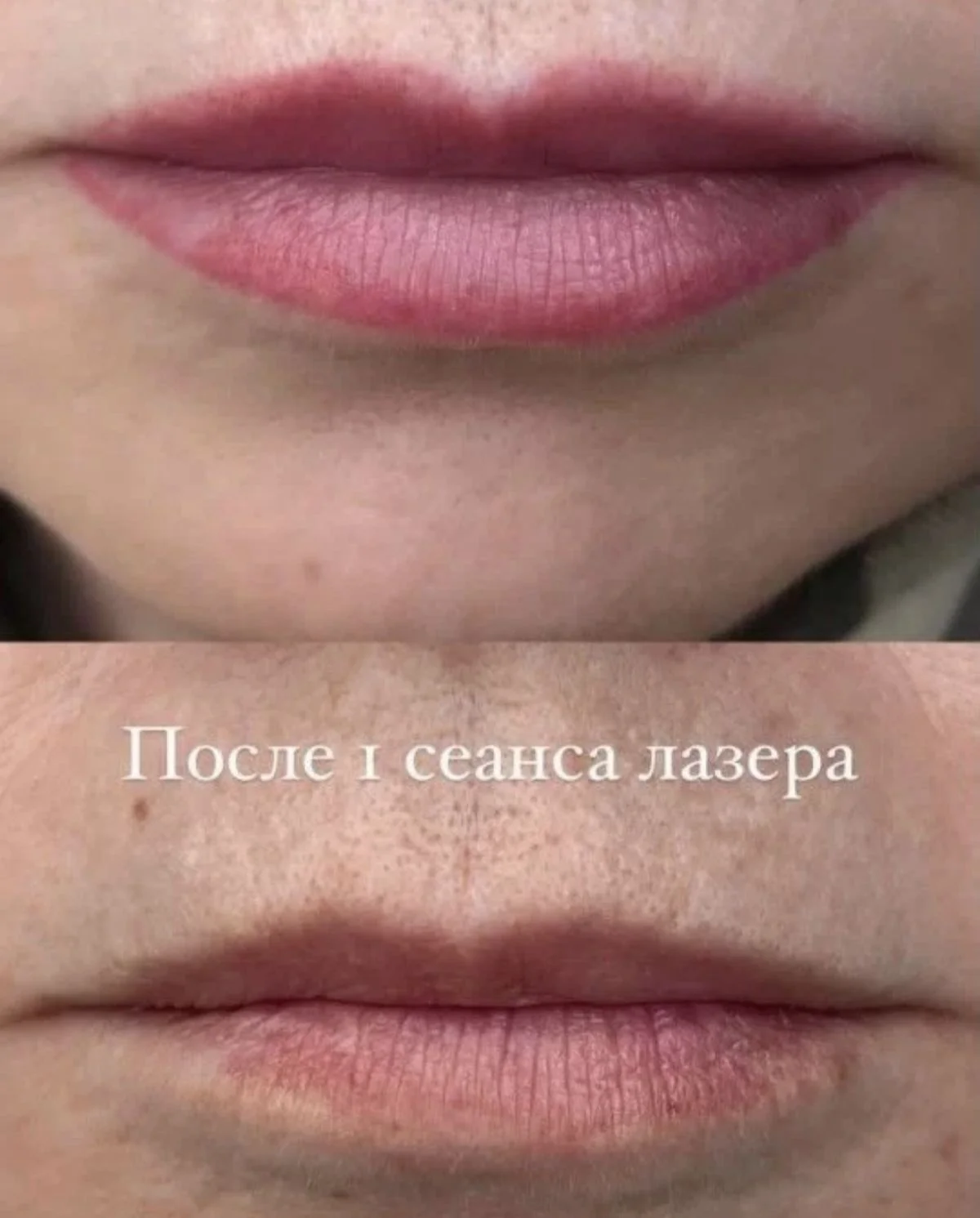 Удаление татуажа и тату Краснодар - миниатюра 9