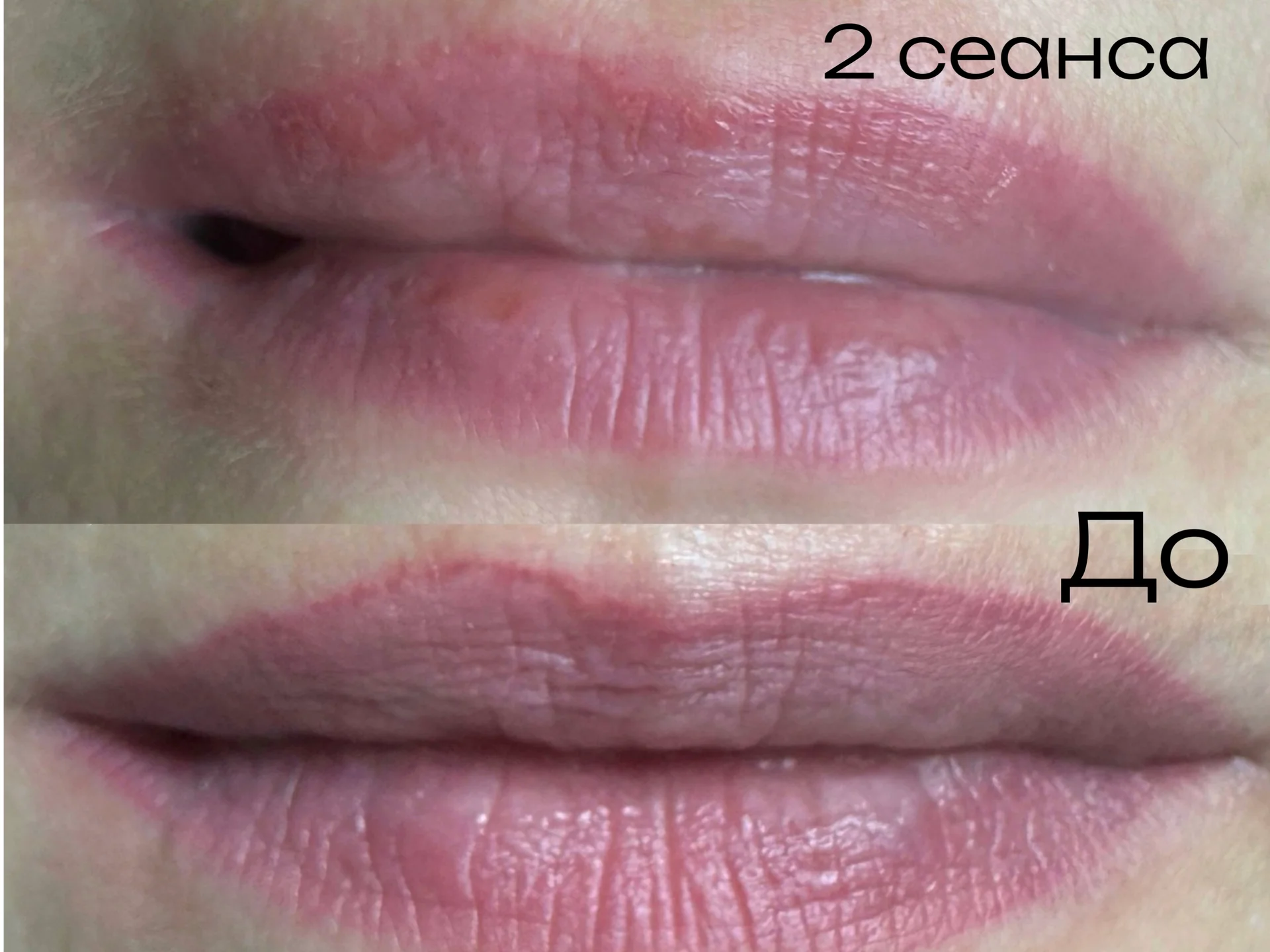 Осветление, удаление татуажа и тату - миниатюра 6