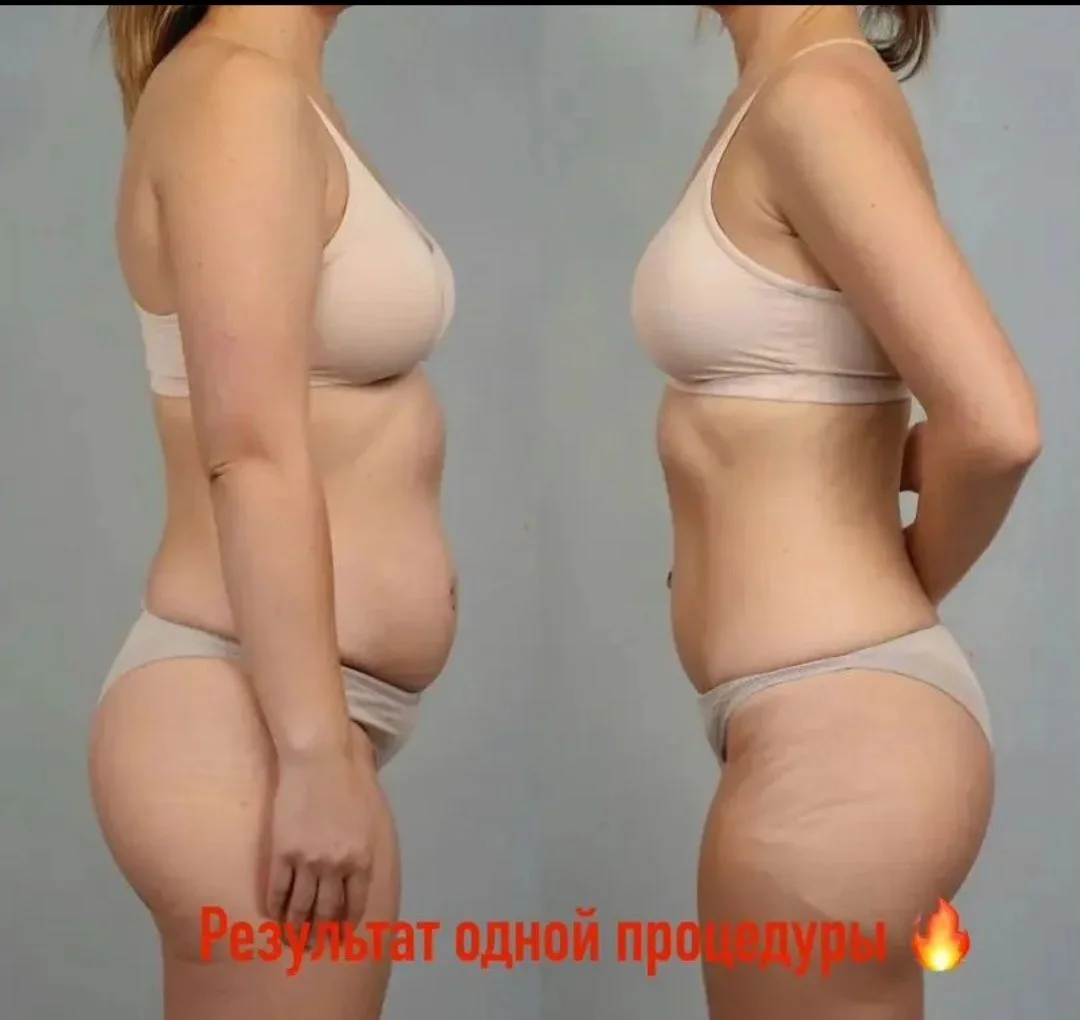 Криолиполиз бесплатно - изображение 1