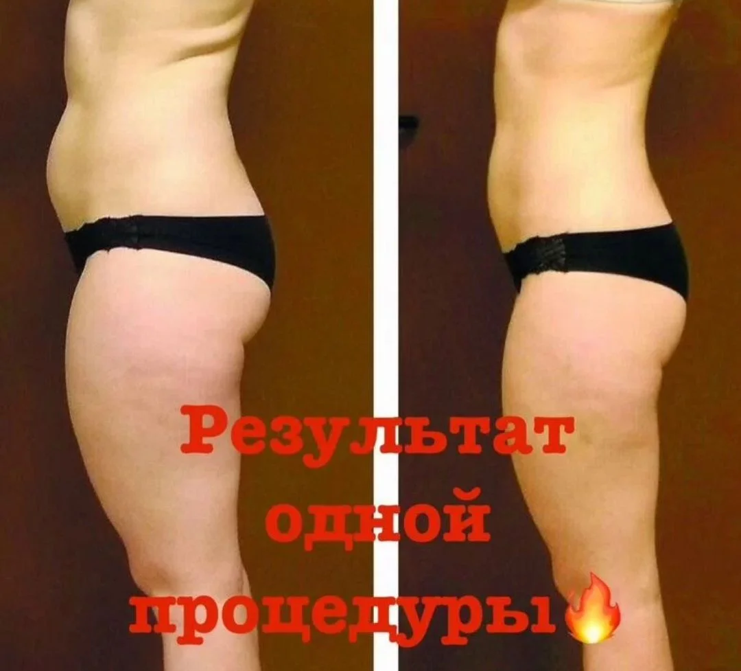 Криолиполиз бесплатно - миниатюра 3