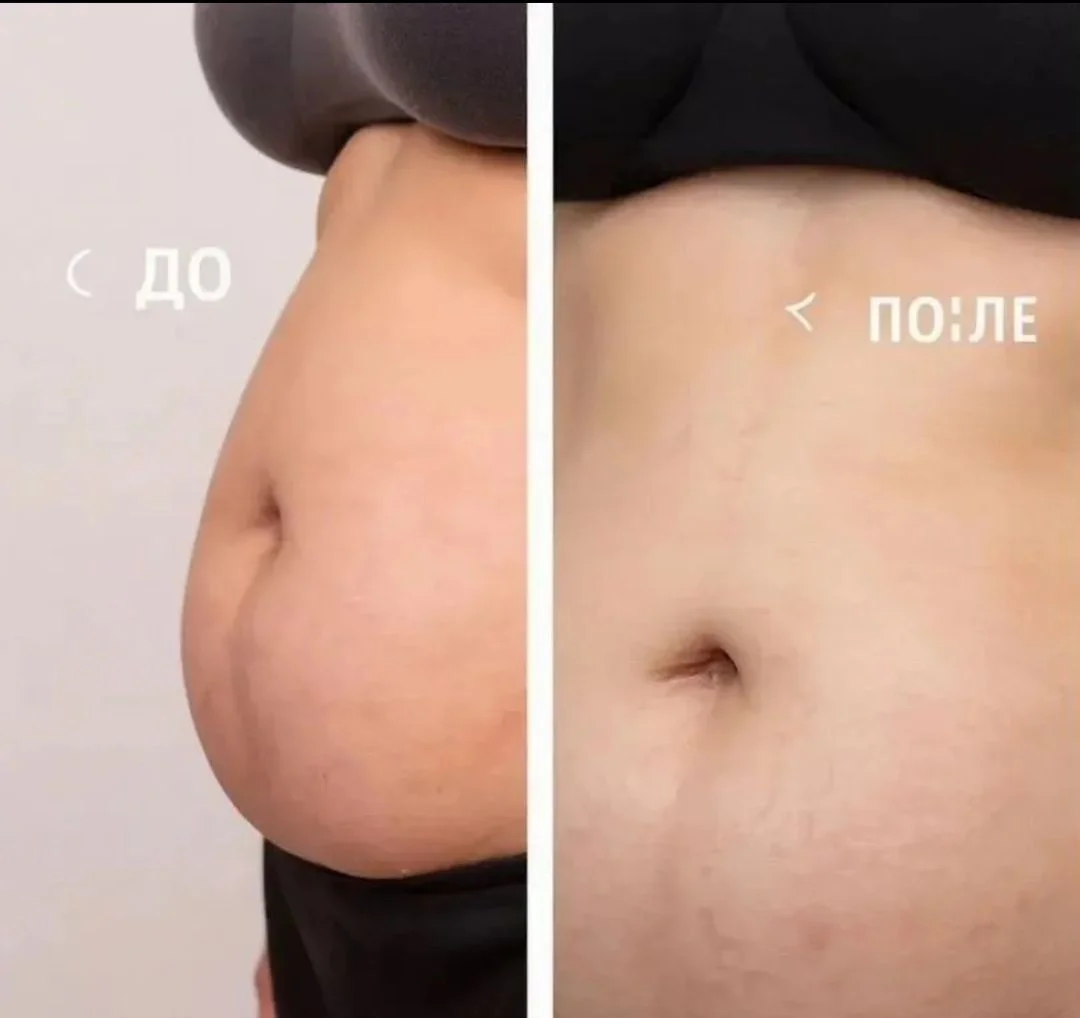 Криолиполиз бесплатно - миниатюра 5