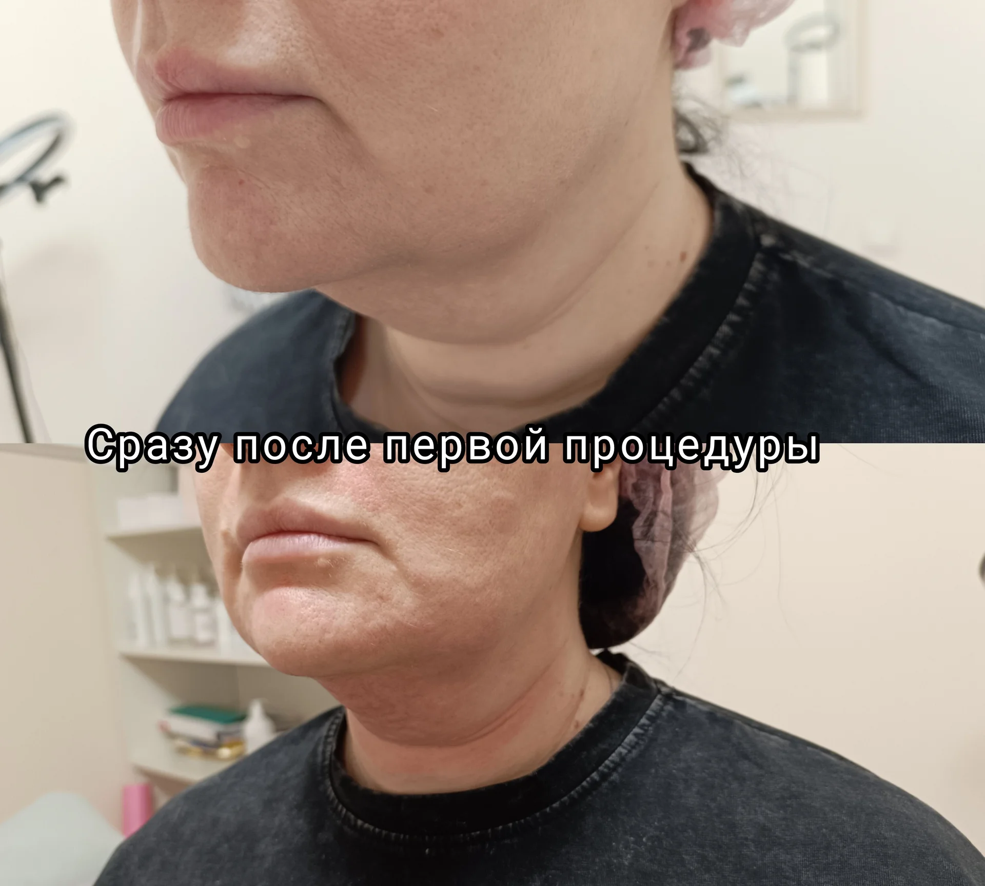 Микроигольчатый Rf-лифтинг - изображение 1