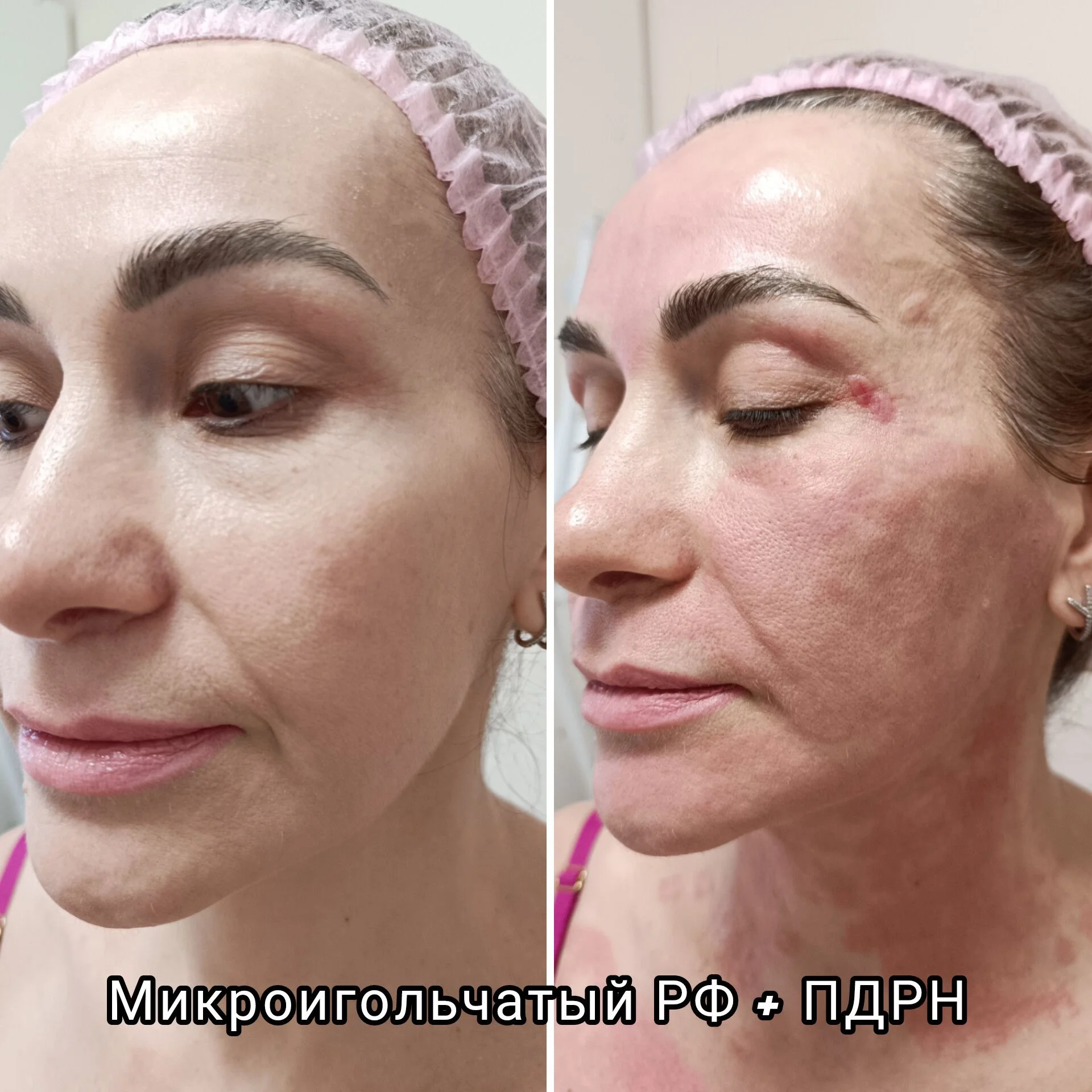 Микроигольчатый Rf-лифтинг - миниатюра 11