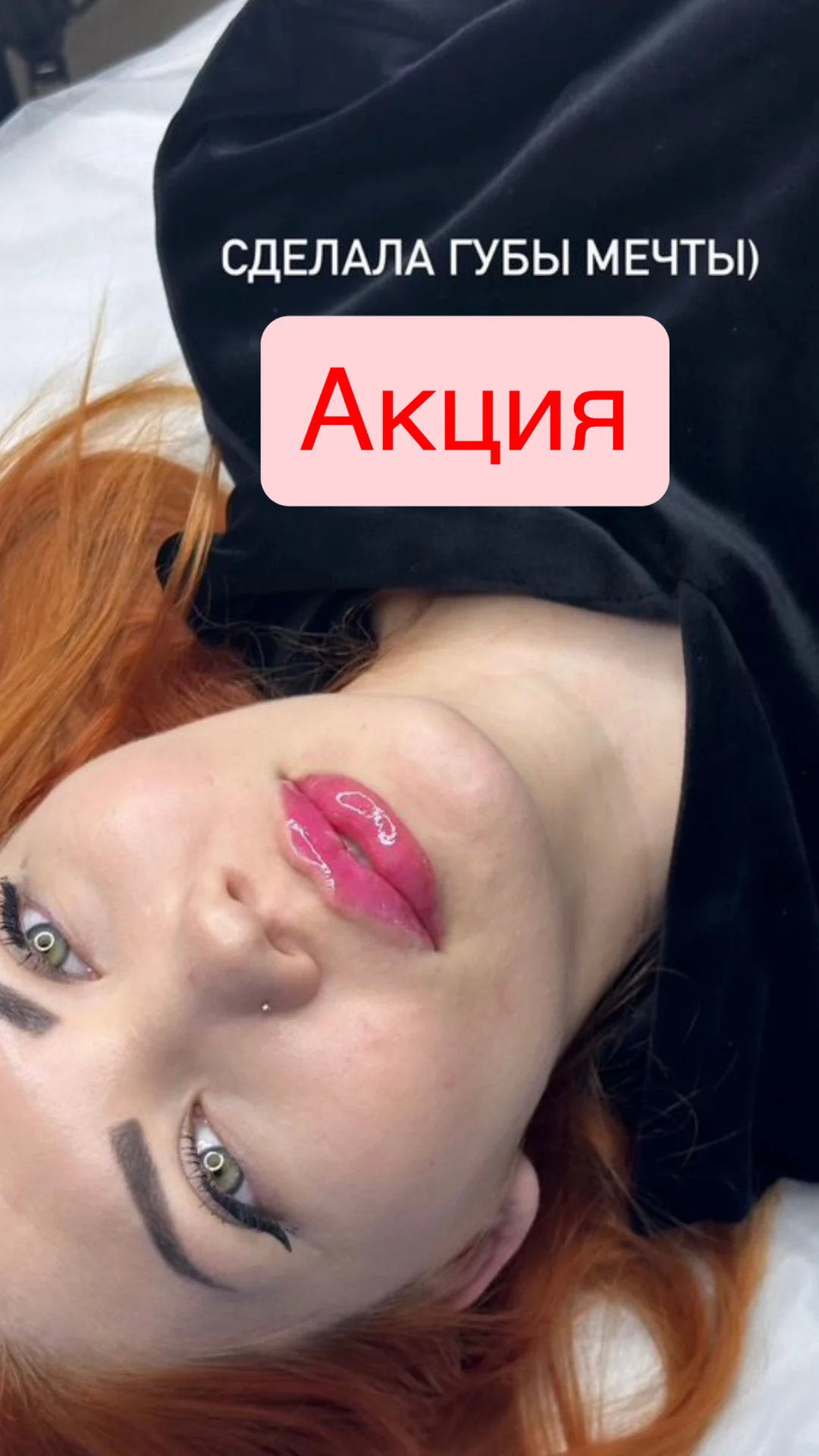 Увеличение губ всеми техниками - изображение 1