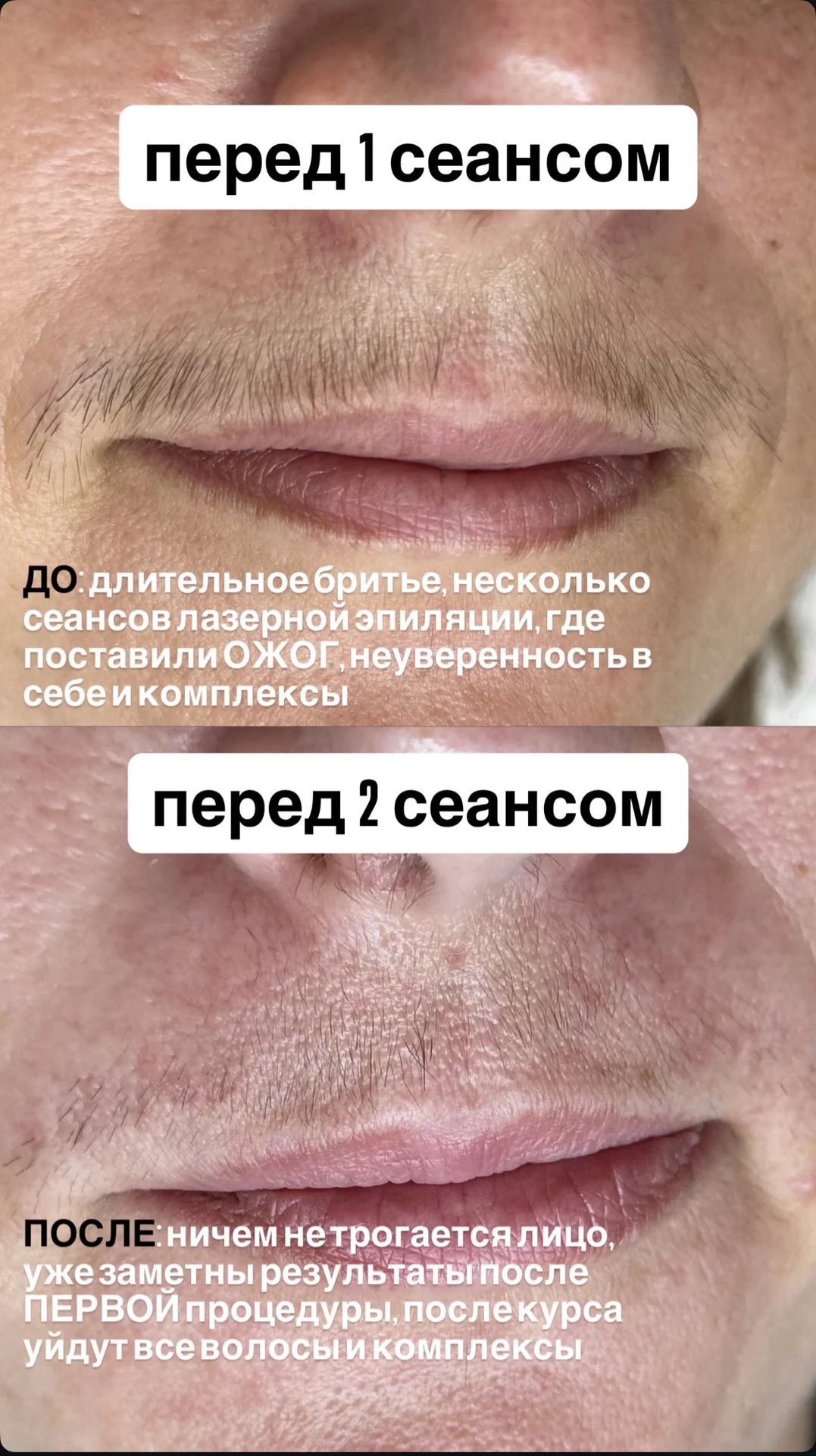 электроэпиляция - миниатюра 3