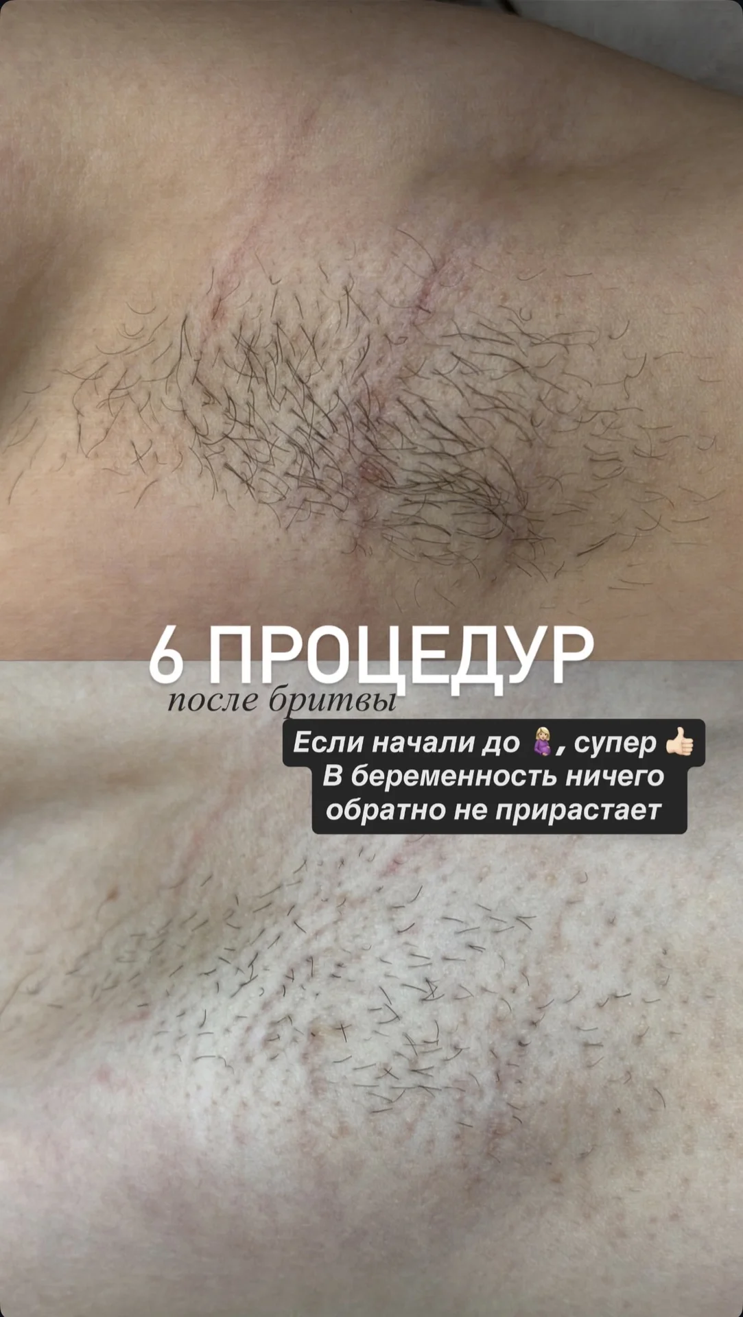 электроэпиляция - миниатюра 5