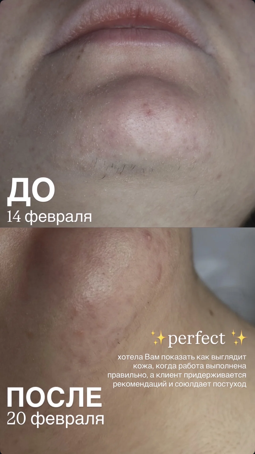 электроэпиляция - миниатюра 6