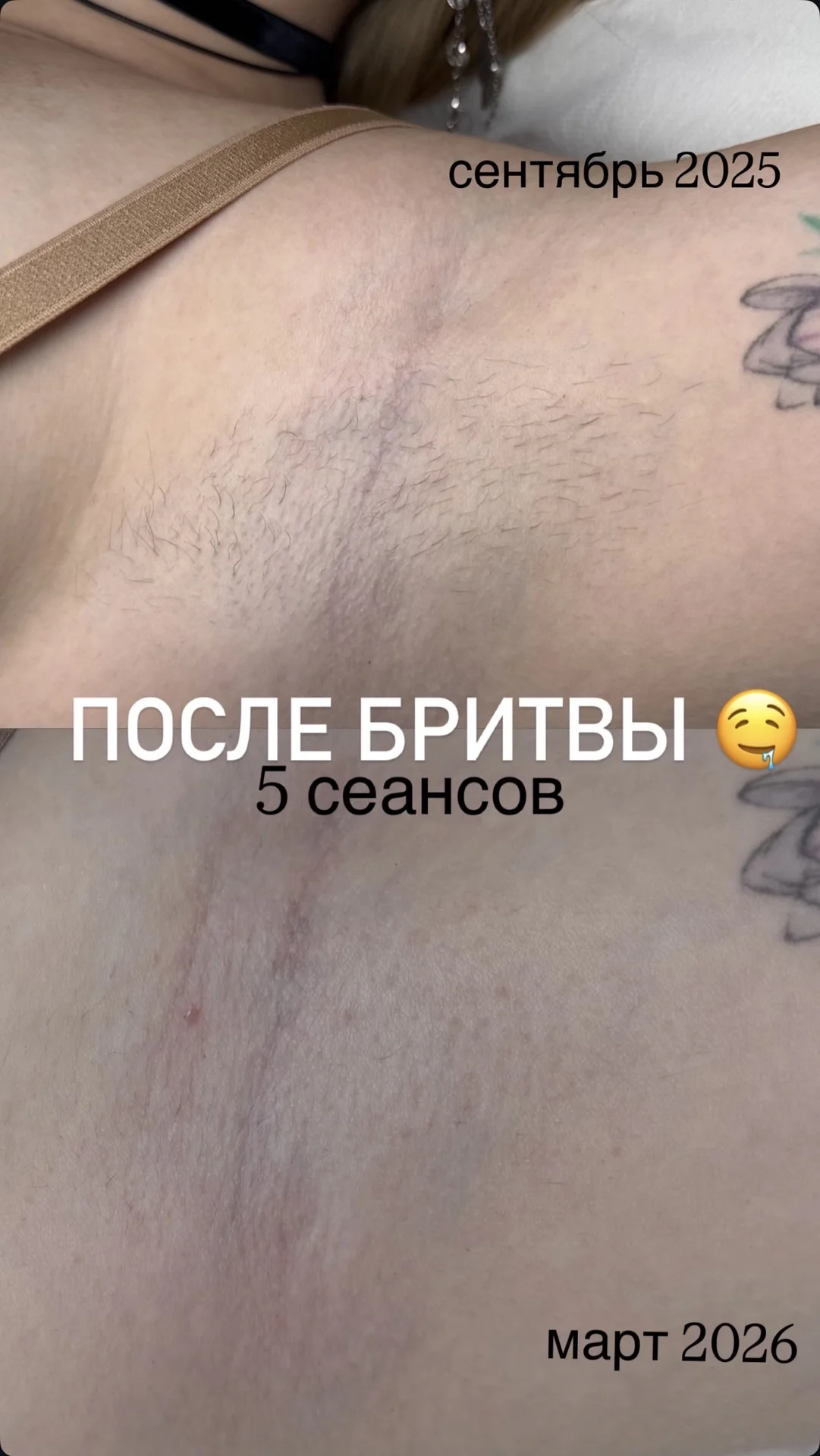 электроэпиляция - миниатюра 7