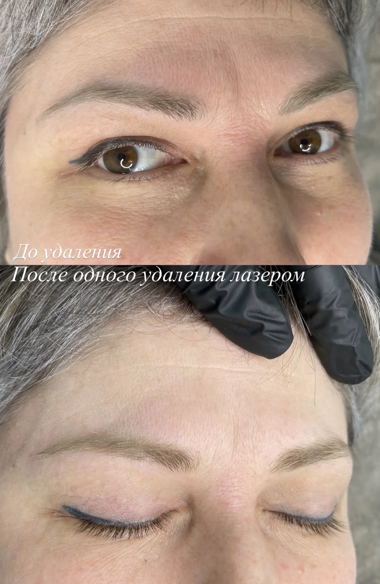 Удаление татуажа - миниатюра 3