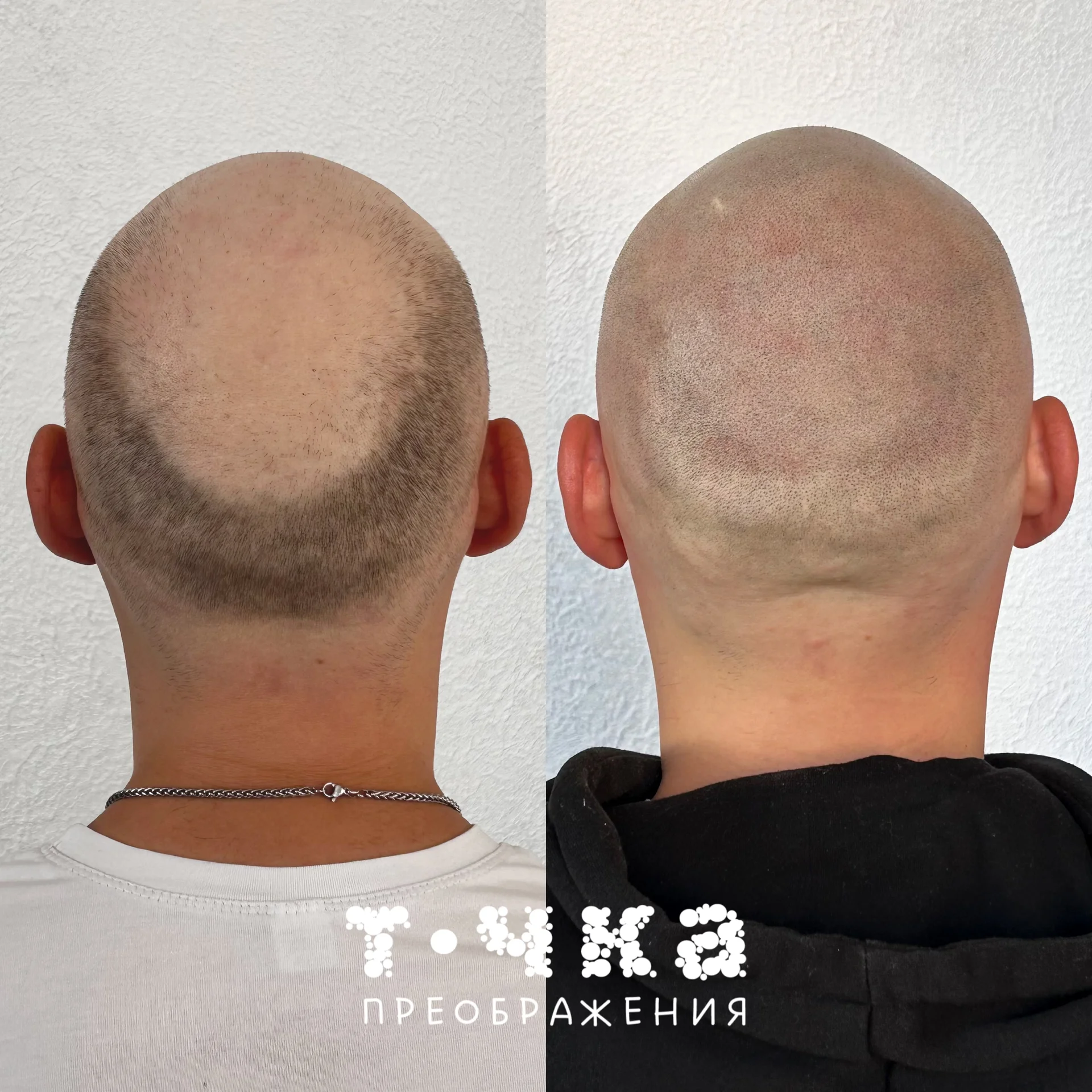 Трихопигментация SMP - миниатюра 2