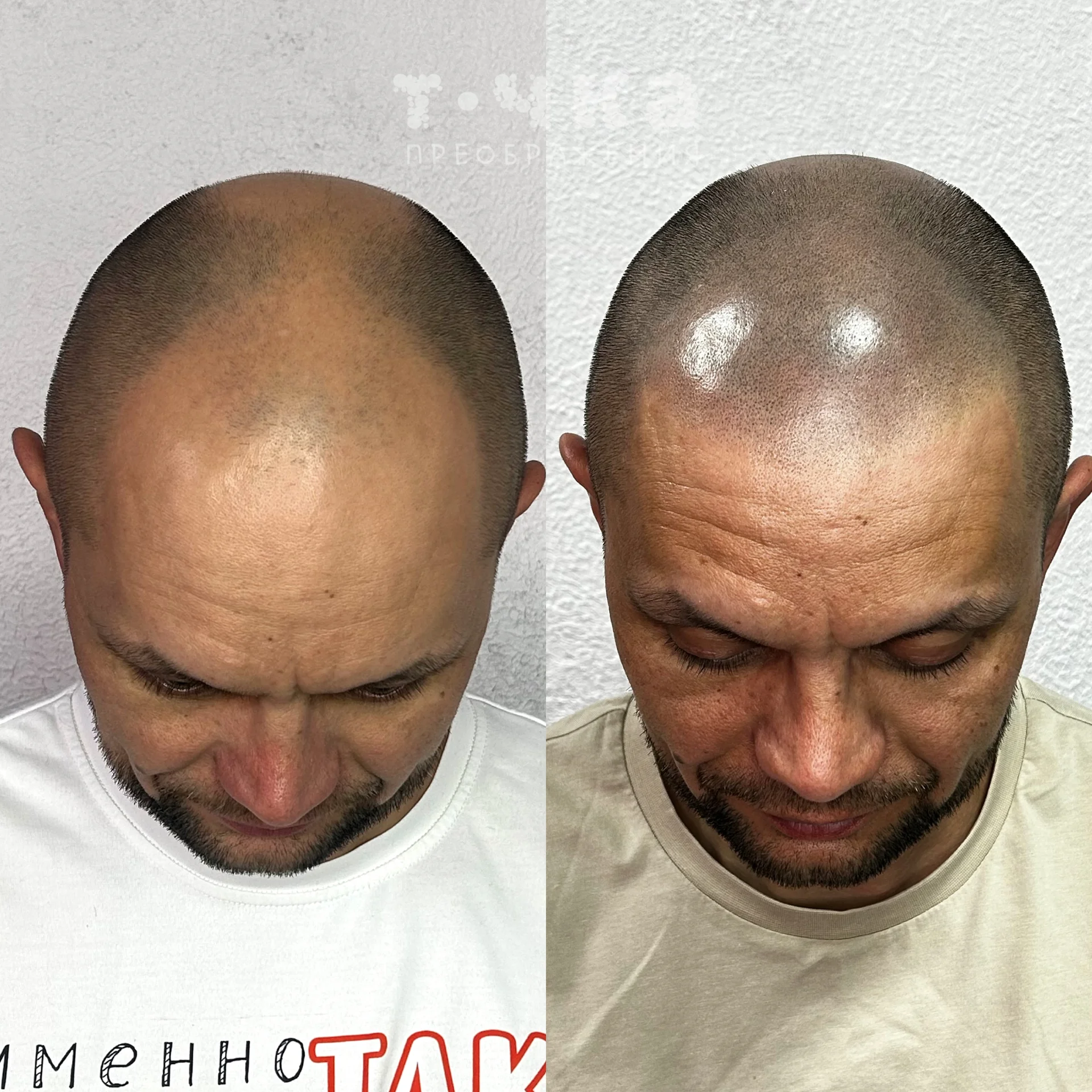 Трихопигментация SMP - миниатюра 9