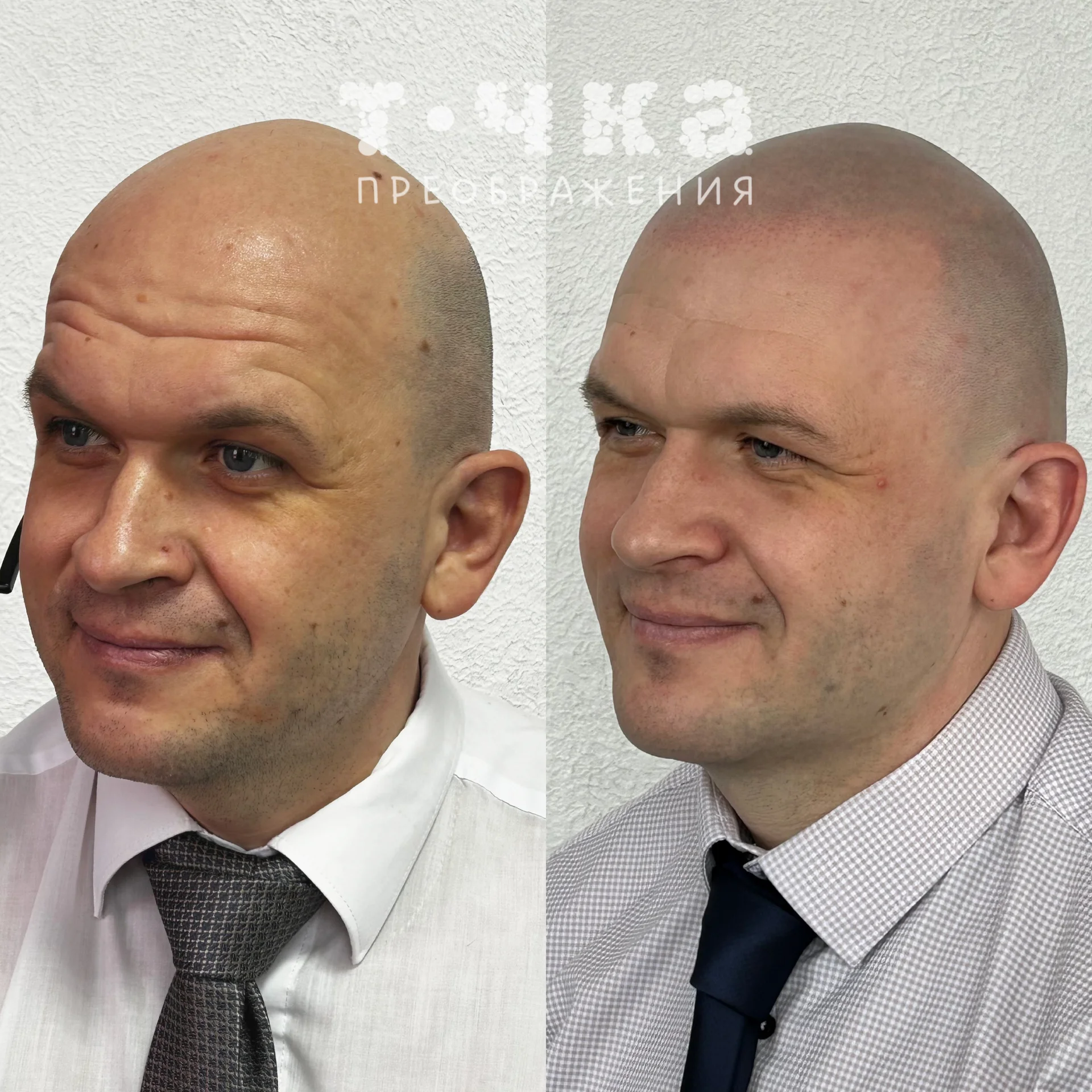 Трихопигментация SMP - миниатюра 11