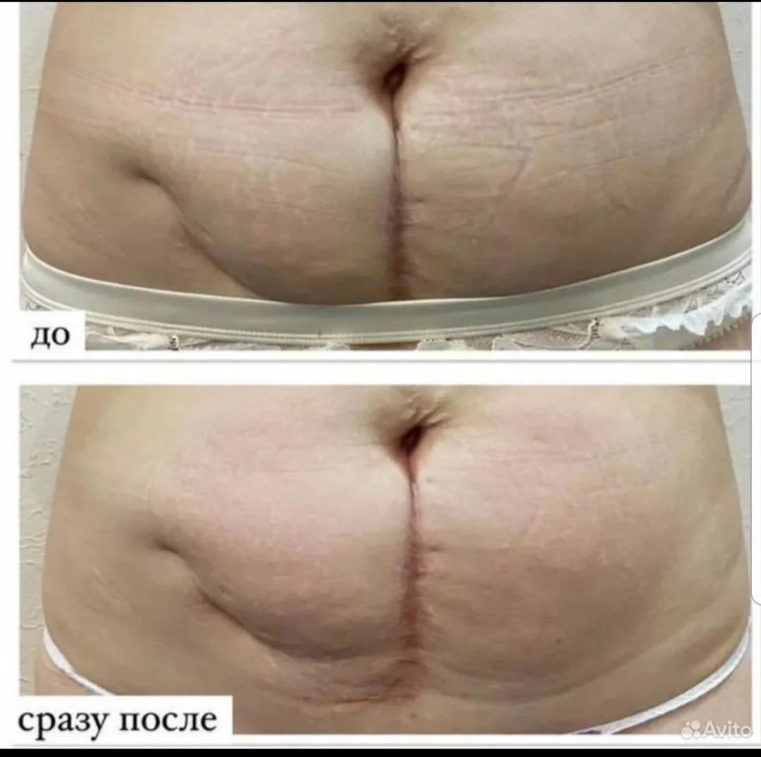 Массаж коррекция фигуры и похудение - миниатюра 3