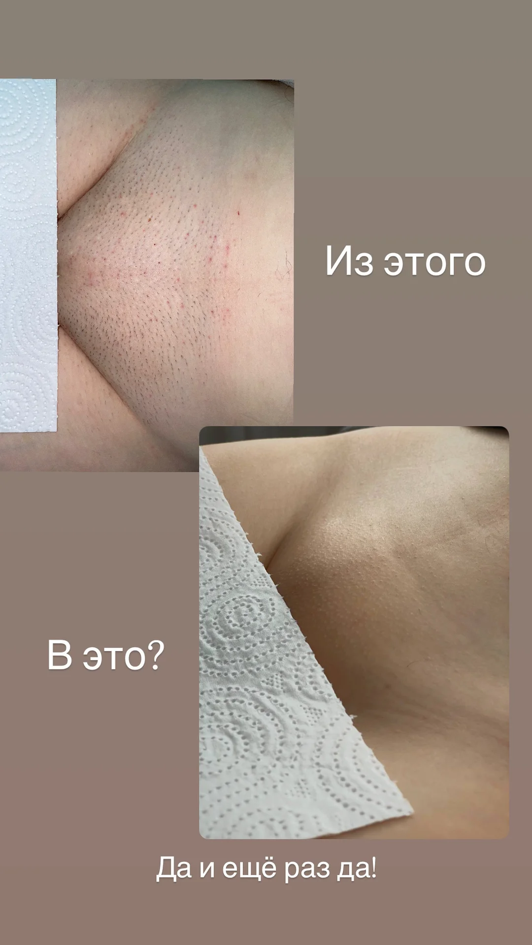Лазерная эпиляция для женщин и мужчин - миниатюра 6