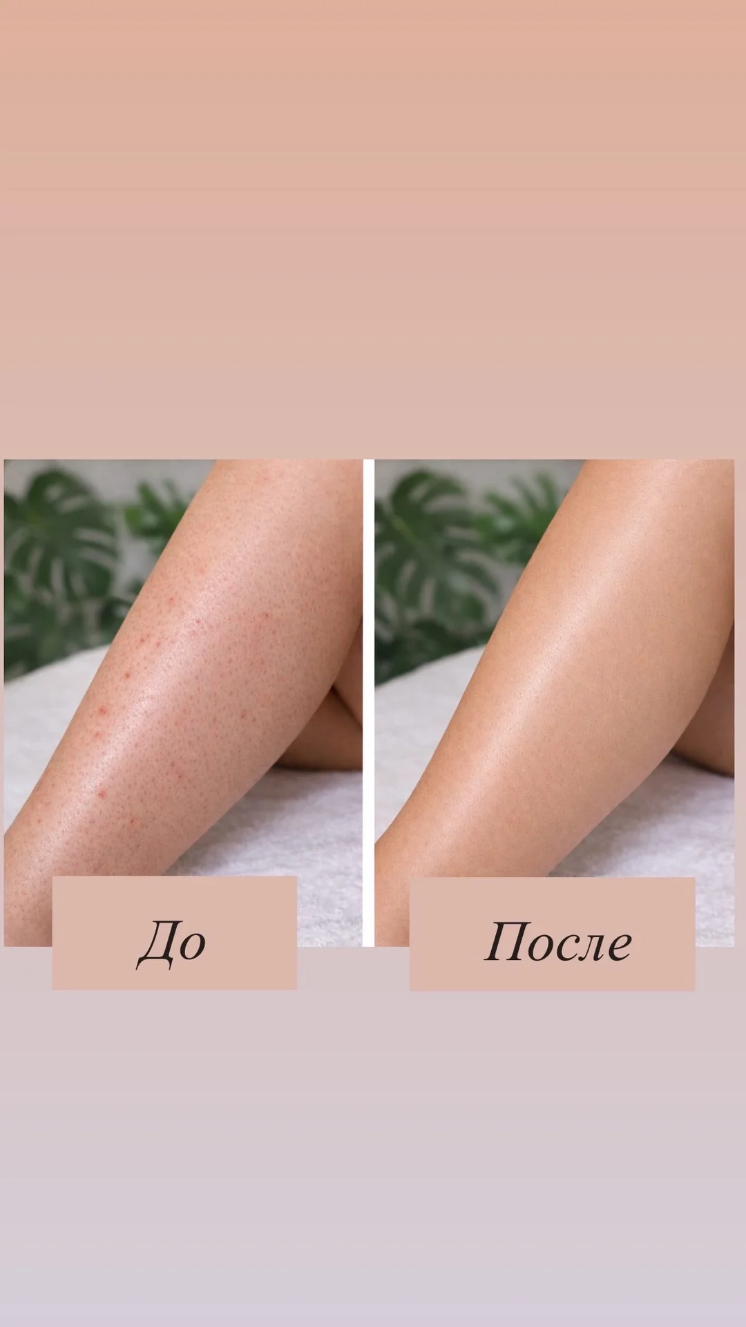 Лазерная эпиляция для женщин и мужчин - миниатюра 7