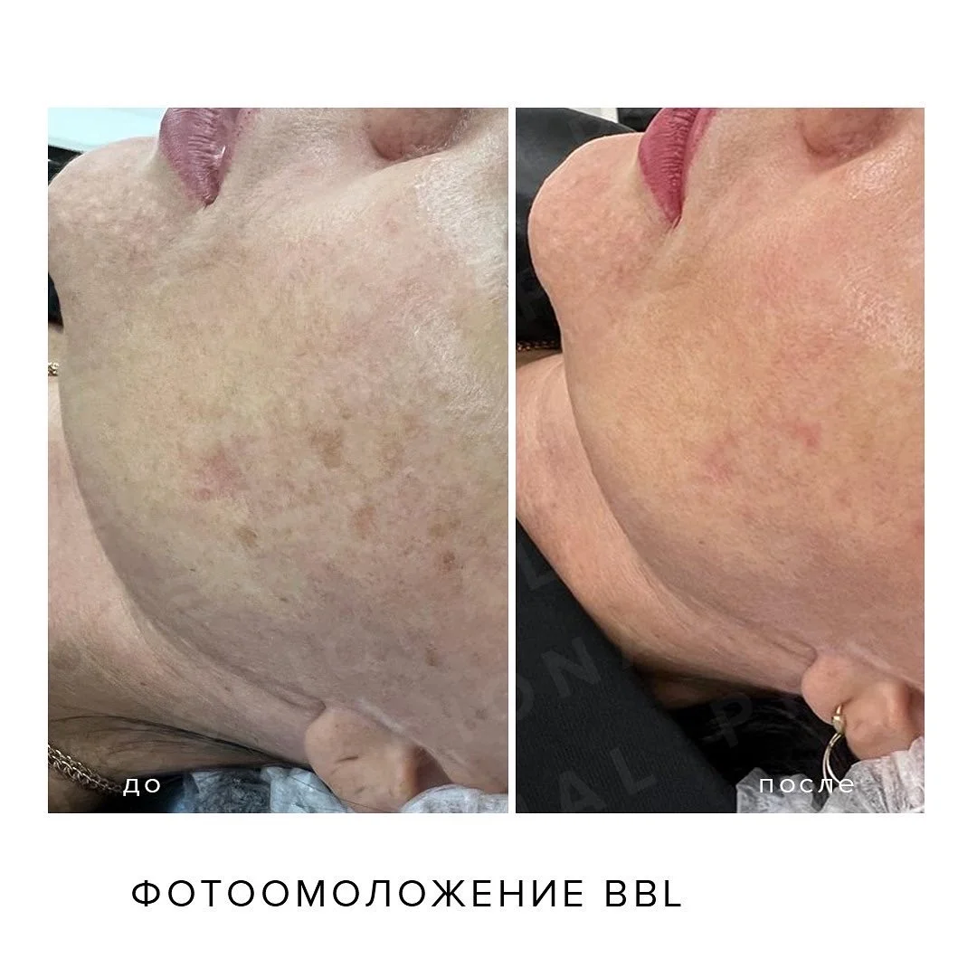 BBL фотоомоложение фотолечение (оригинал) - миниатюра 3