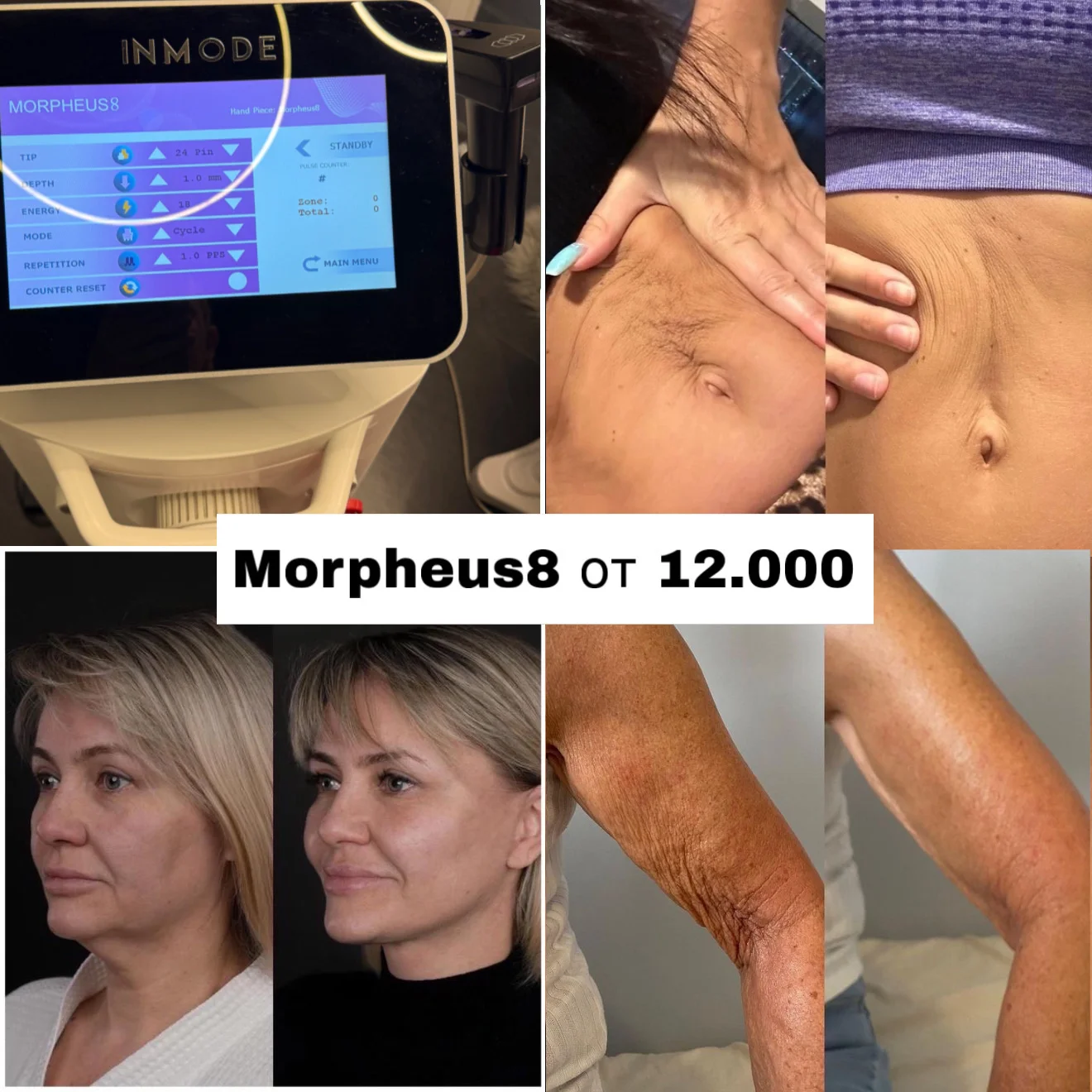 Морфеус 8 Morpheus микроигольчатый рф - изображение 1