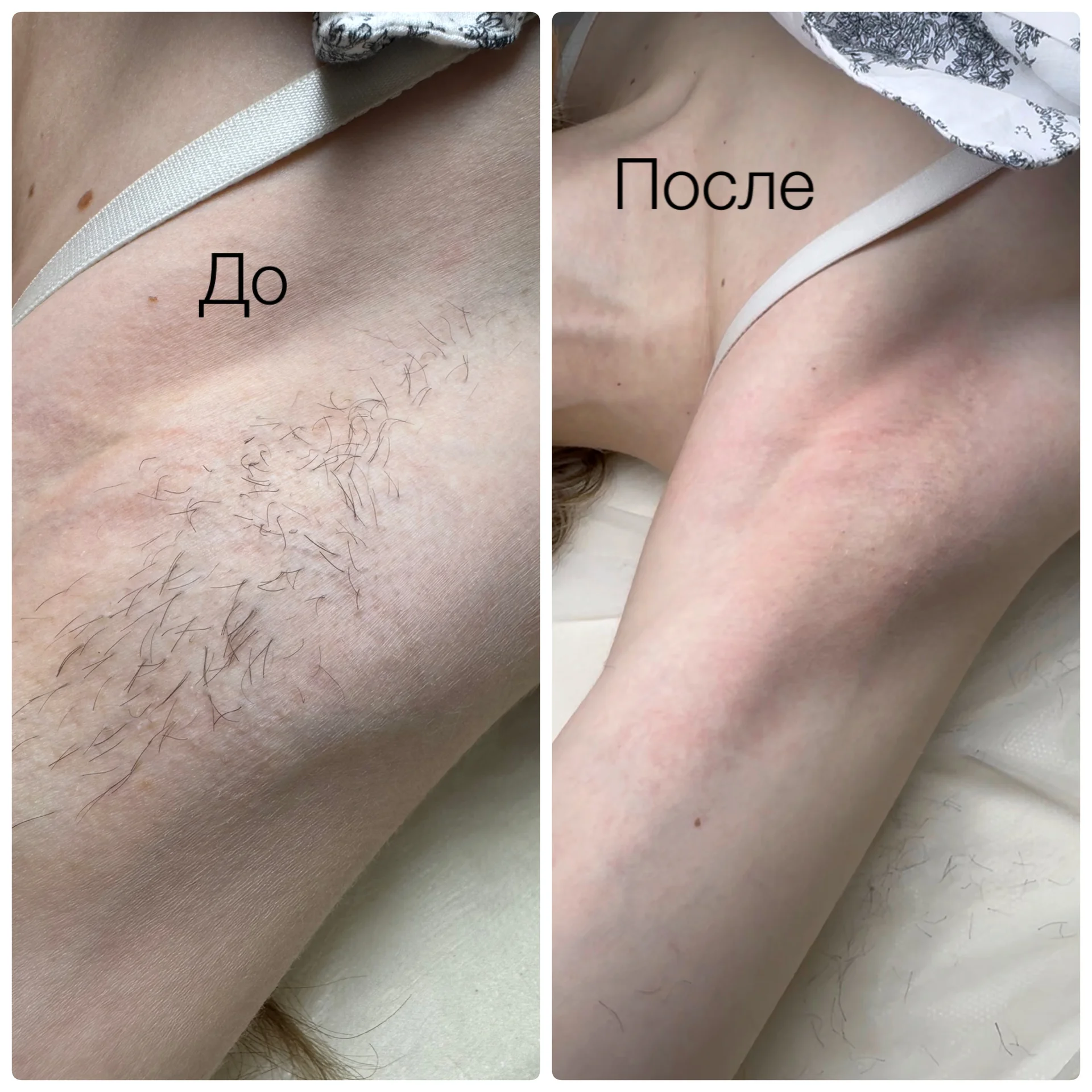 Электроэпиляция - изображение 1