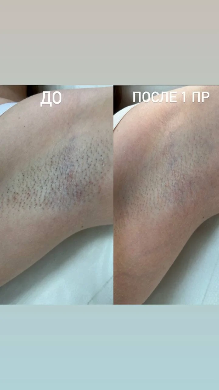 Лазерная эпиляция -30% Фокинский район - миниатюра 2