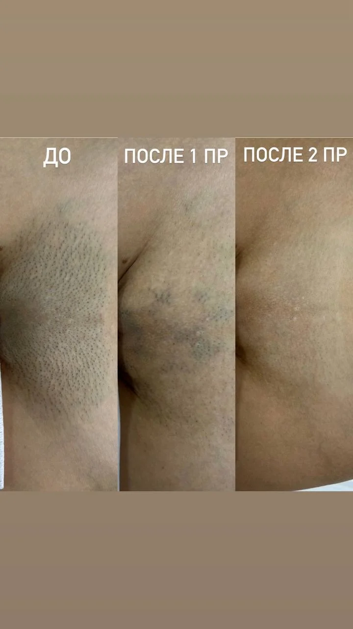 Лазерная эпиляция -30% Фокинский район - миниатюра 3