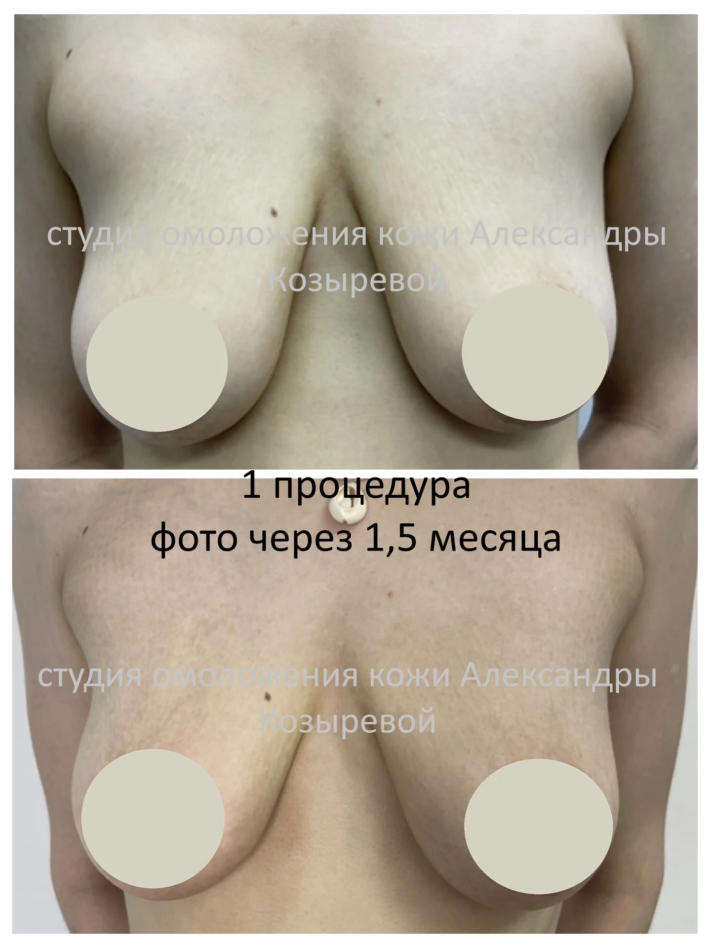 Подтяжка кожи живота и груди - миниатюра 4