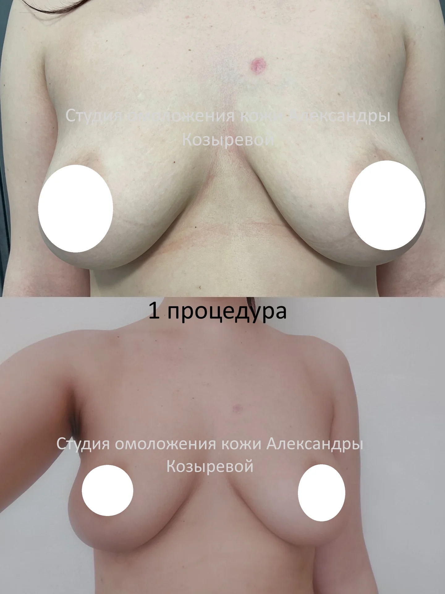 Подтяжка кожи живота и груди - миниатюра 5