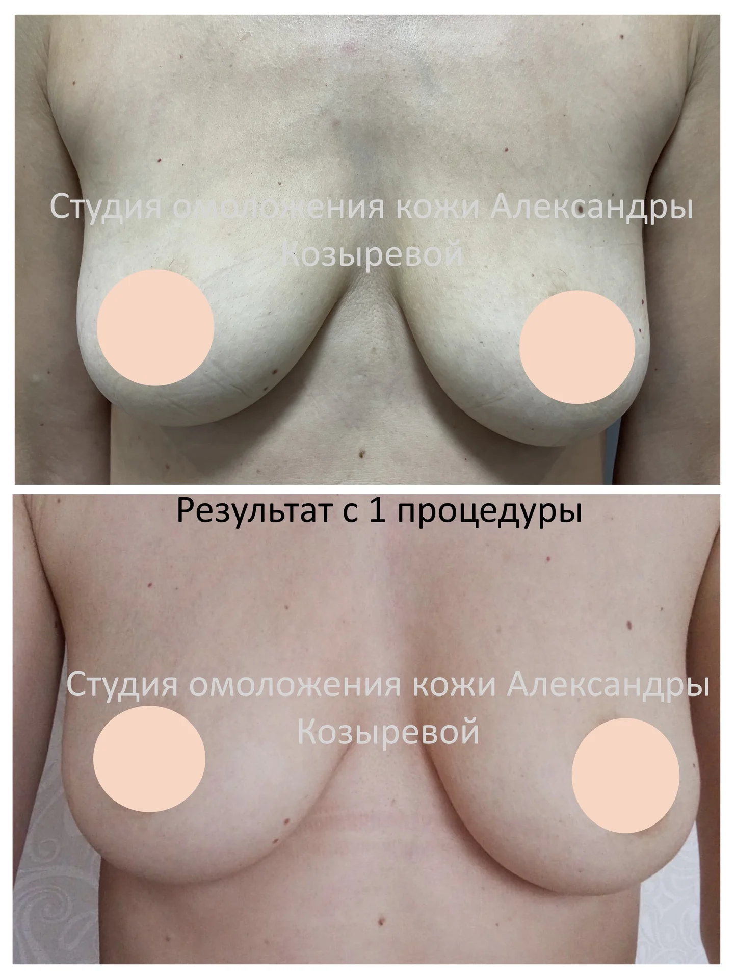 Подтяжка кожи живота и груди - миниатюра 6