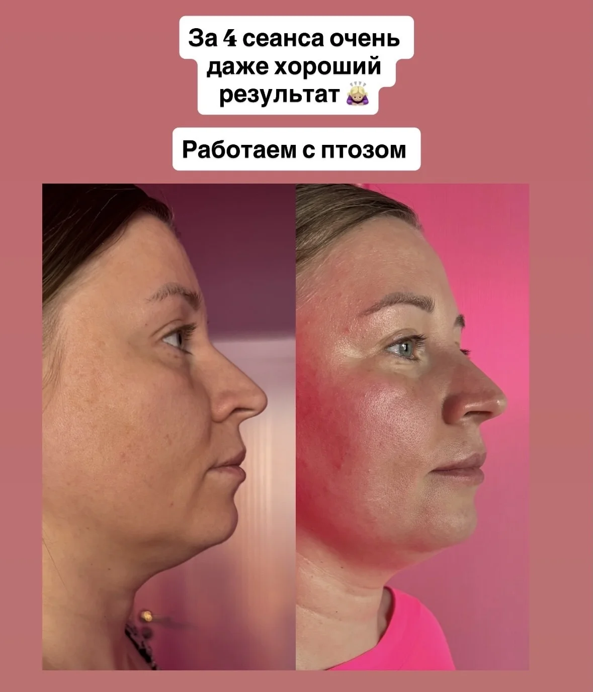 Глубокотканный массаж лица | моделирование лица - миниатюра 3