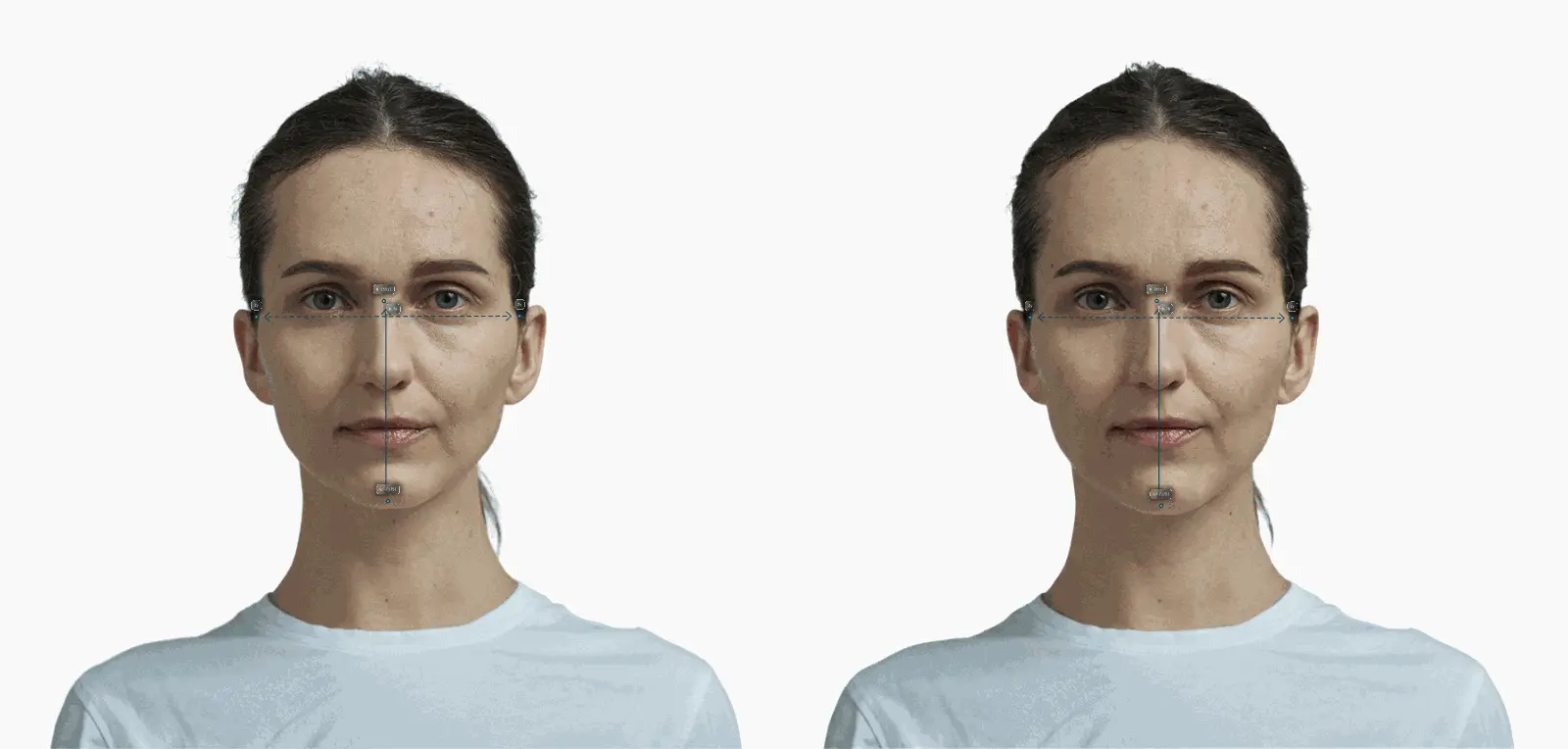 Female frontal portrait with face lengthened, facial index 0.76 to 0.77