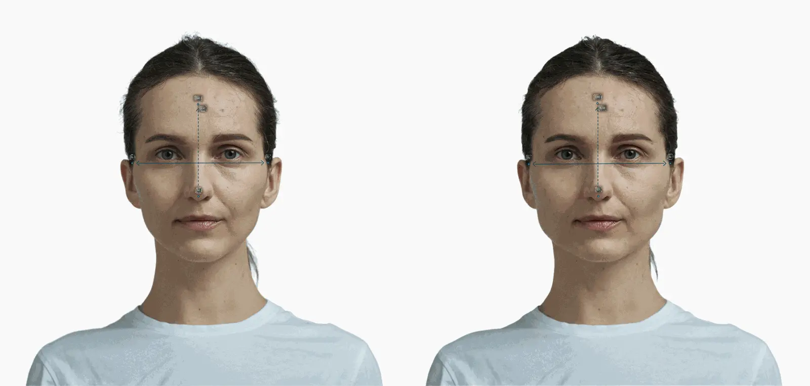 Female frontal portrait with lower face widened, FWHR 1.47 to 1.49