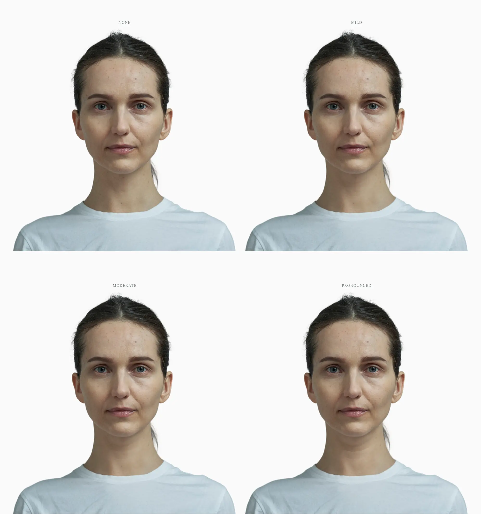 One face at four stages of a double chin, from none to pronounced