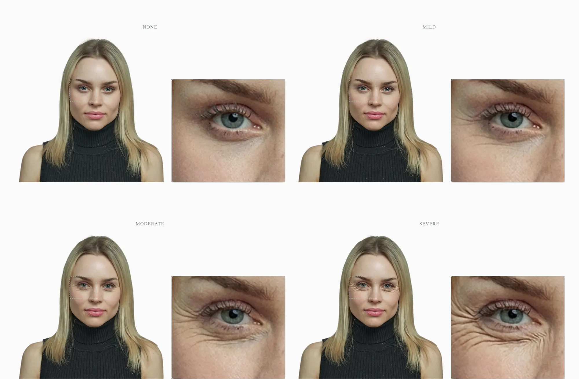 Four stages of crow's feet severity on the same female face, each shown as a portrait plus a zoom on the eye