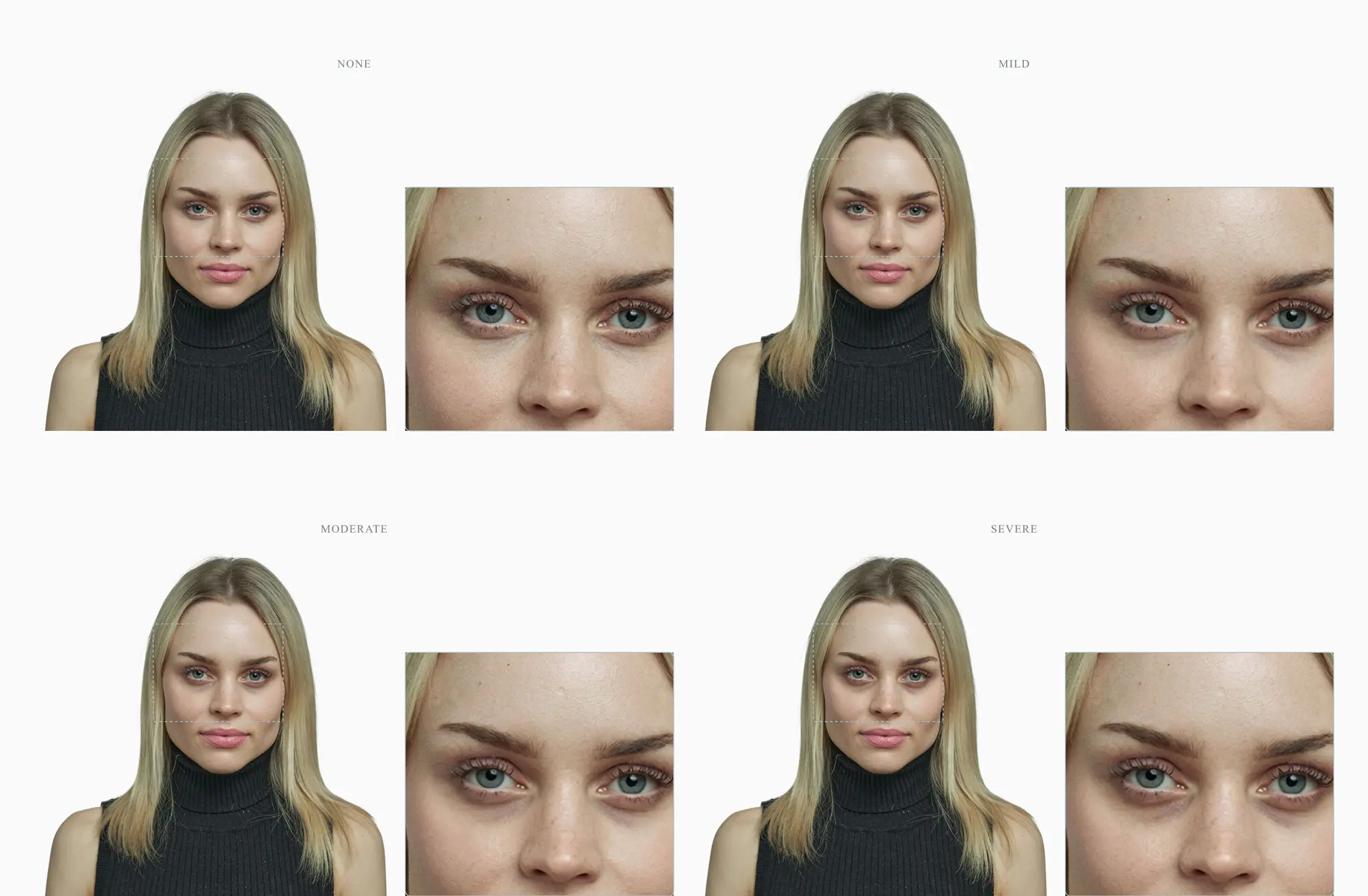 Under-eye dark-circle severity progression on a single face — none, mild, moderate, severe