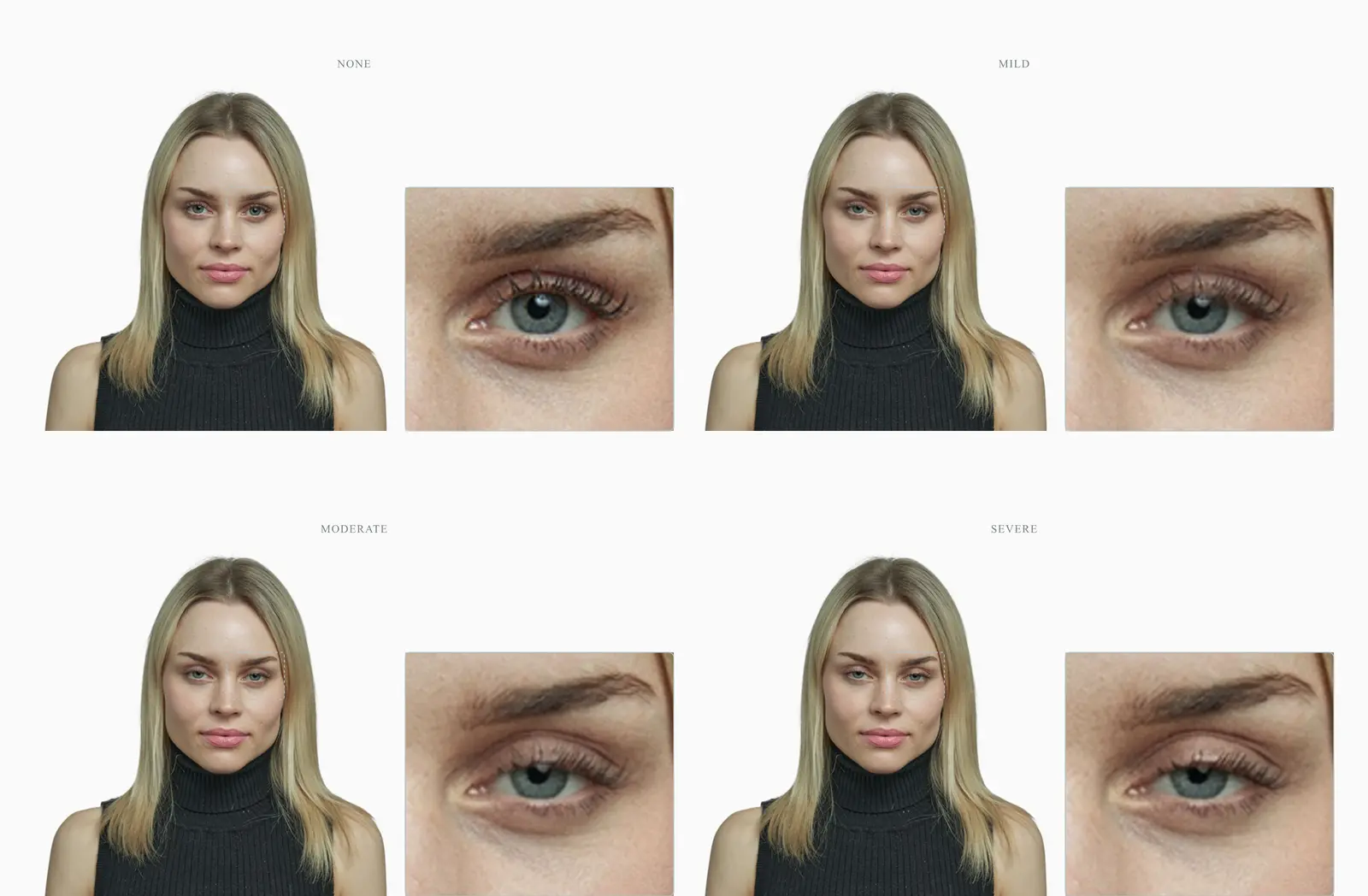 Eyelid ptosis severity from none to severe on a single face, lid margin descending