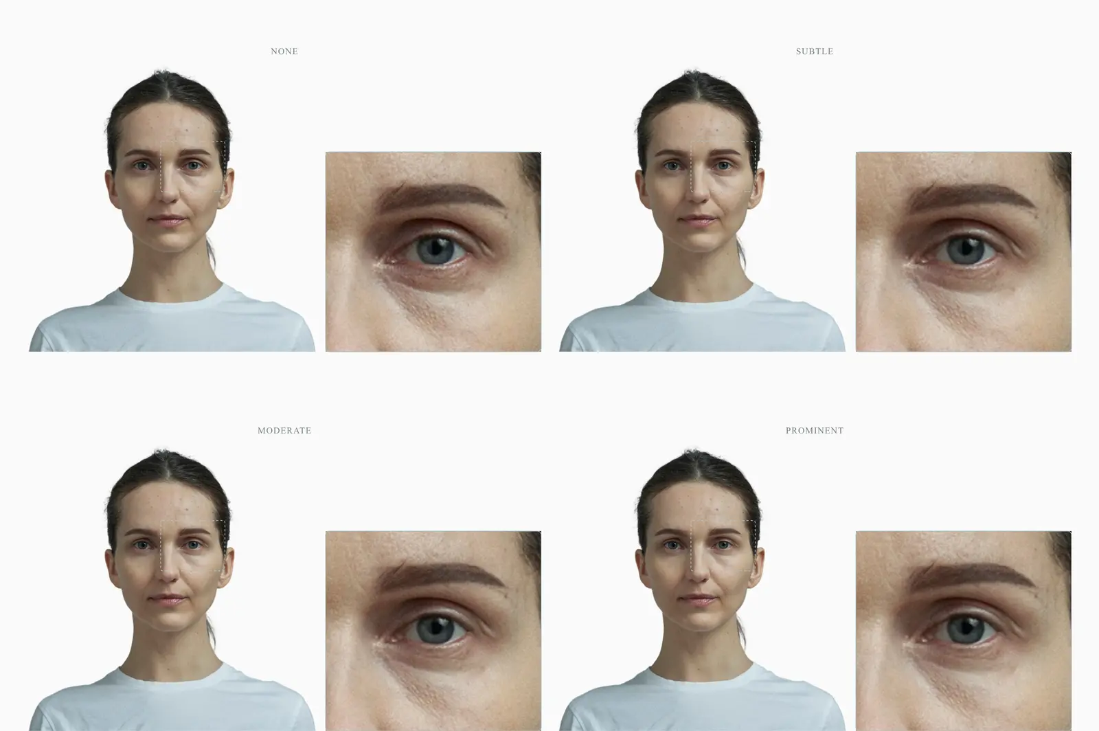 One female face shown at four levels of epicanthic-fold prominence from none to prominent, single inner-corner zoom panel beside each frame