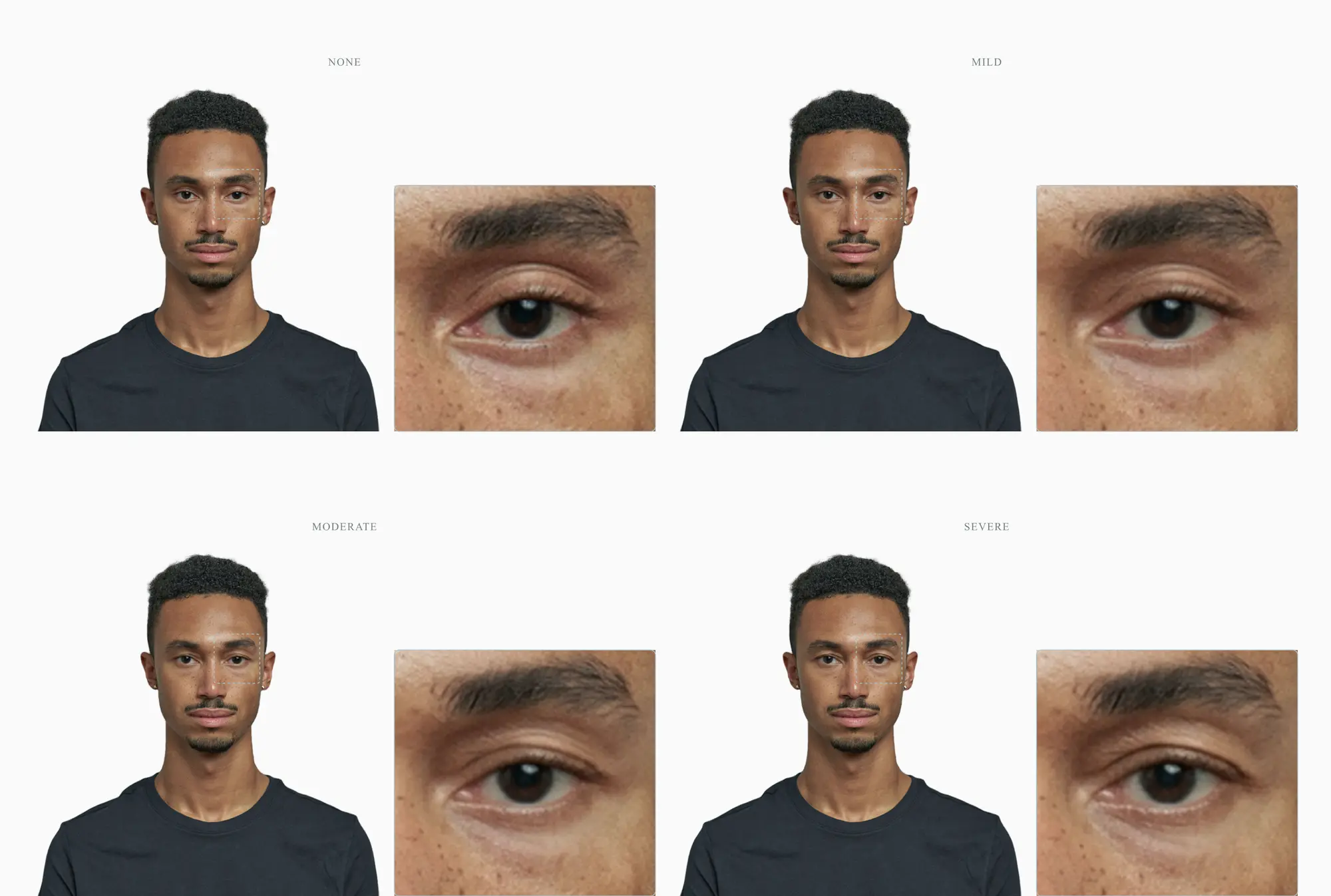 Hooded eyes at four stages, none to severe, with a single-eye zoom in each panel