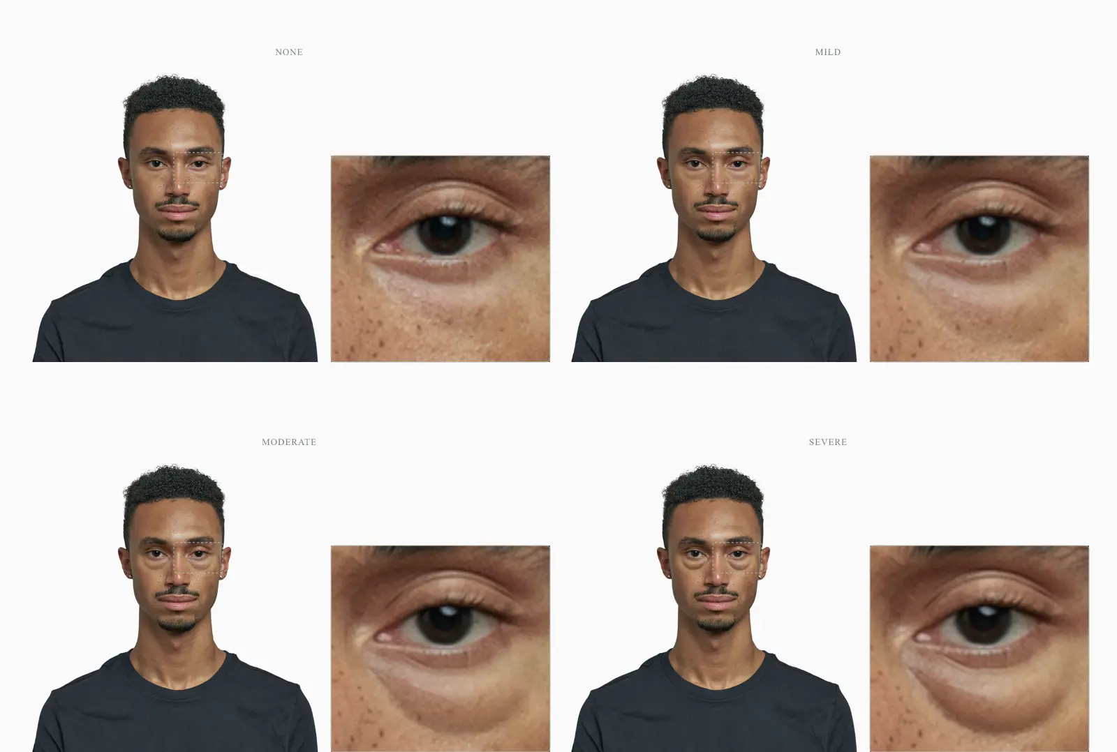 Four-stage severity progression of nasojugal fat pads from none to severe on the same face, with a zoomed under-eye panel beside each portrait
