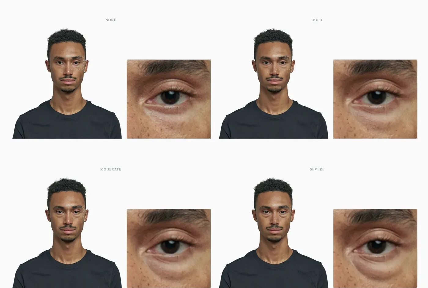 Lower-lid bag severity progression from absent to severe across four stages