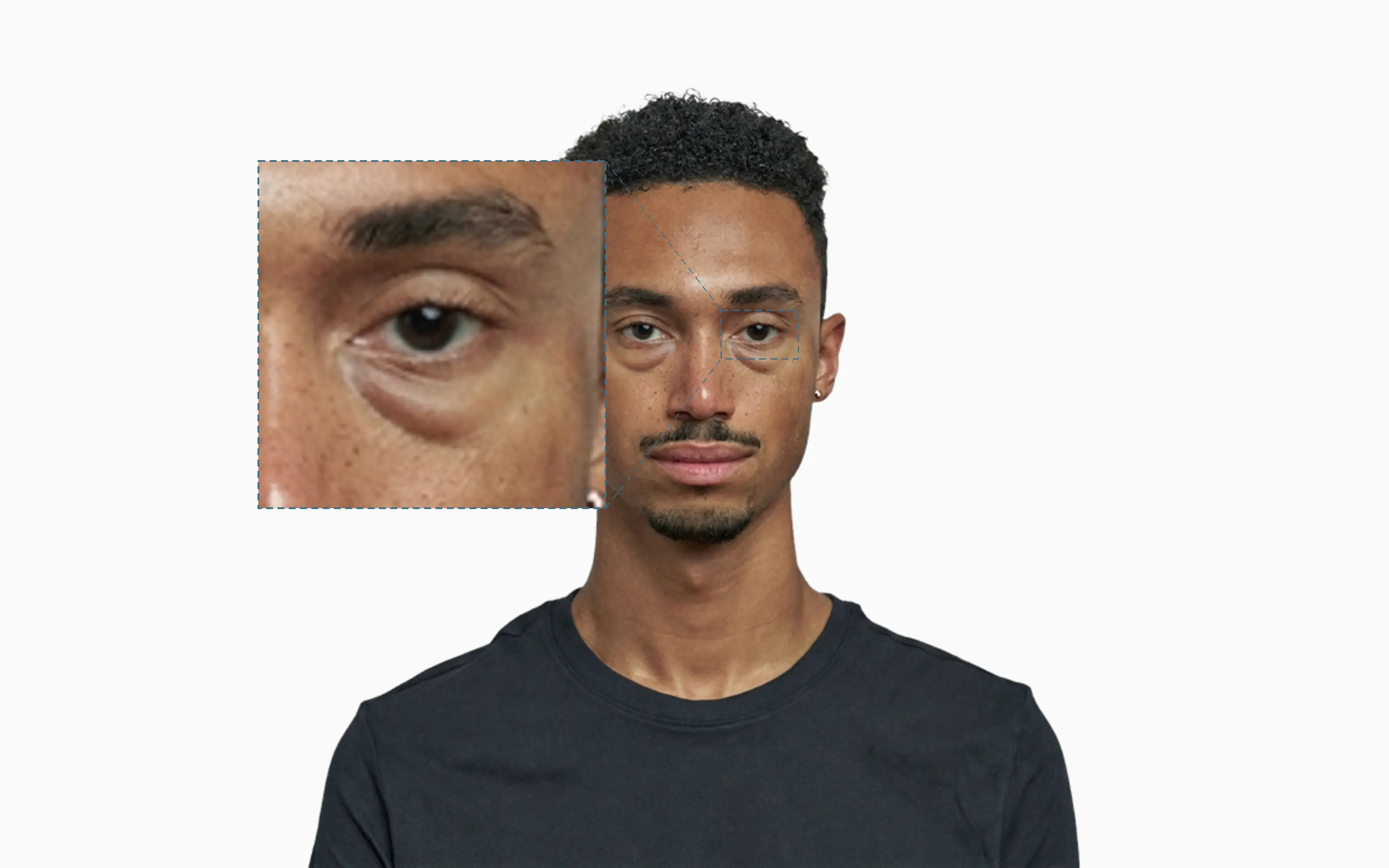 Puffy lower-eyelid bags, callout zoom on the under-eye region