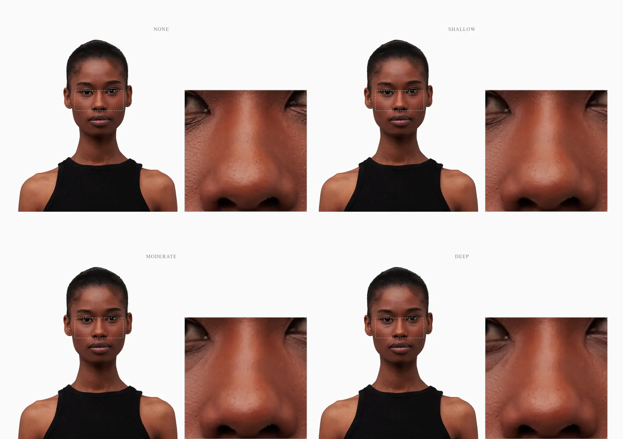 One face at four tear trough depths, none to deep, under-eye area magnified
