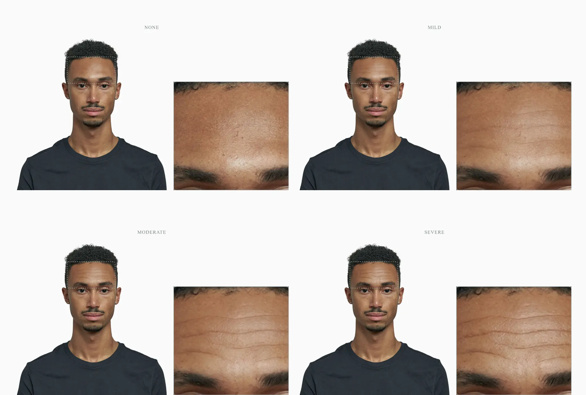 One forehead across four stages, from smooth to deeply creased horizontal lines