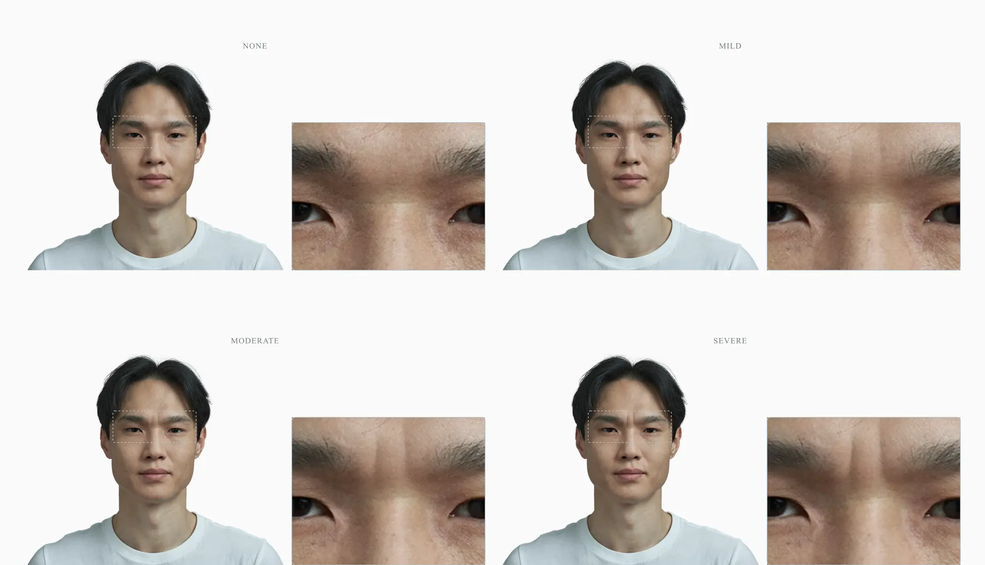 Frown lines deepening across four stages between the eyebrows on the same face