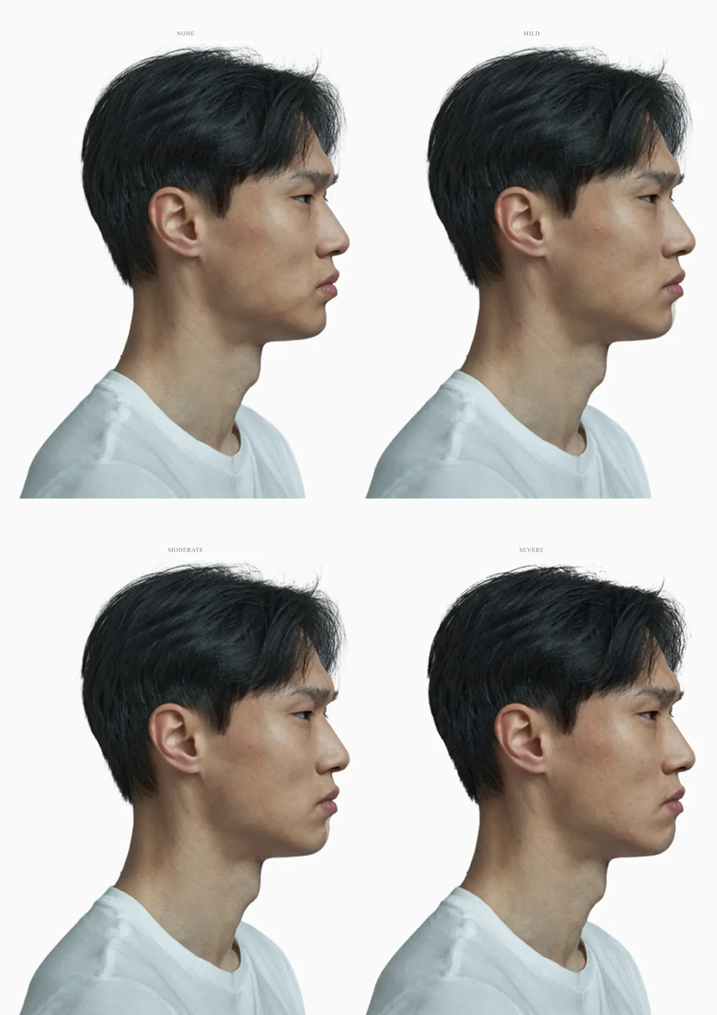 Four-stage severity progression of mandibular retrognathia on a single male profile from none to severe, identity and framing held constant