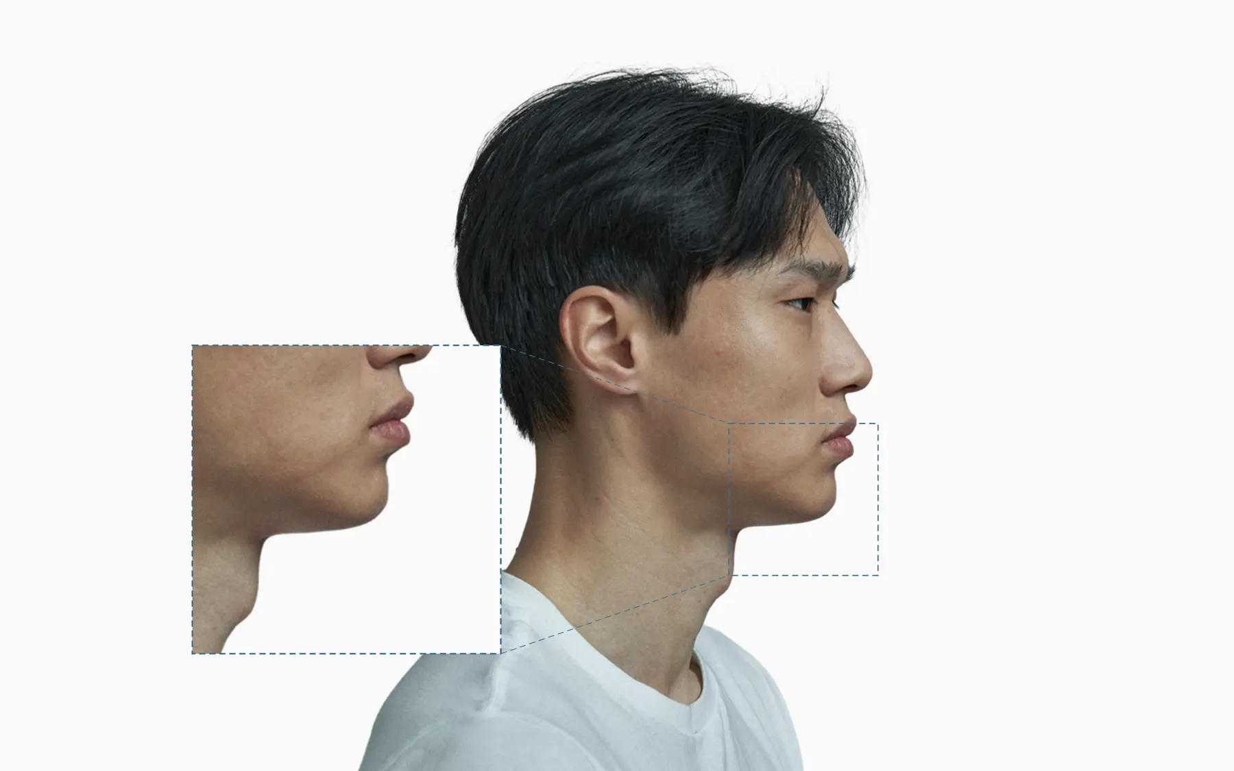 Male profile portrait with a dashed callout on the lower face and an adjacent zoom panel highlighting the recessed chin and mandibular contour