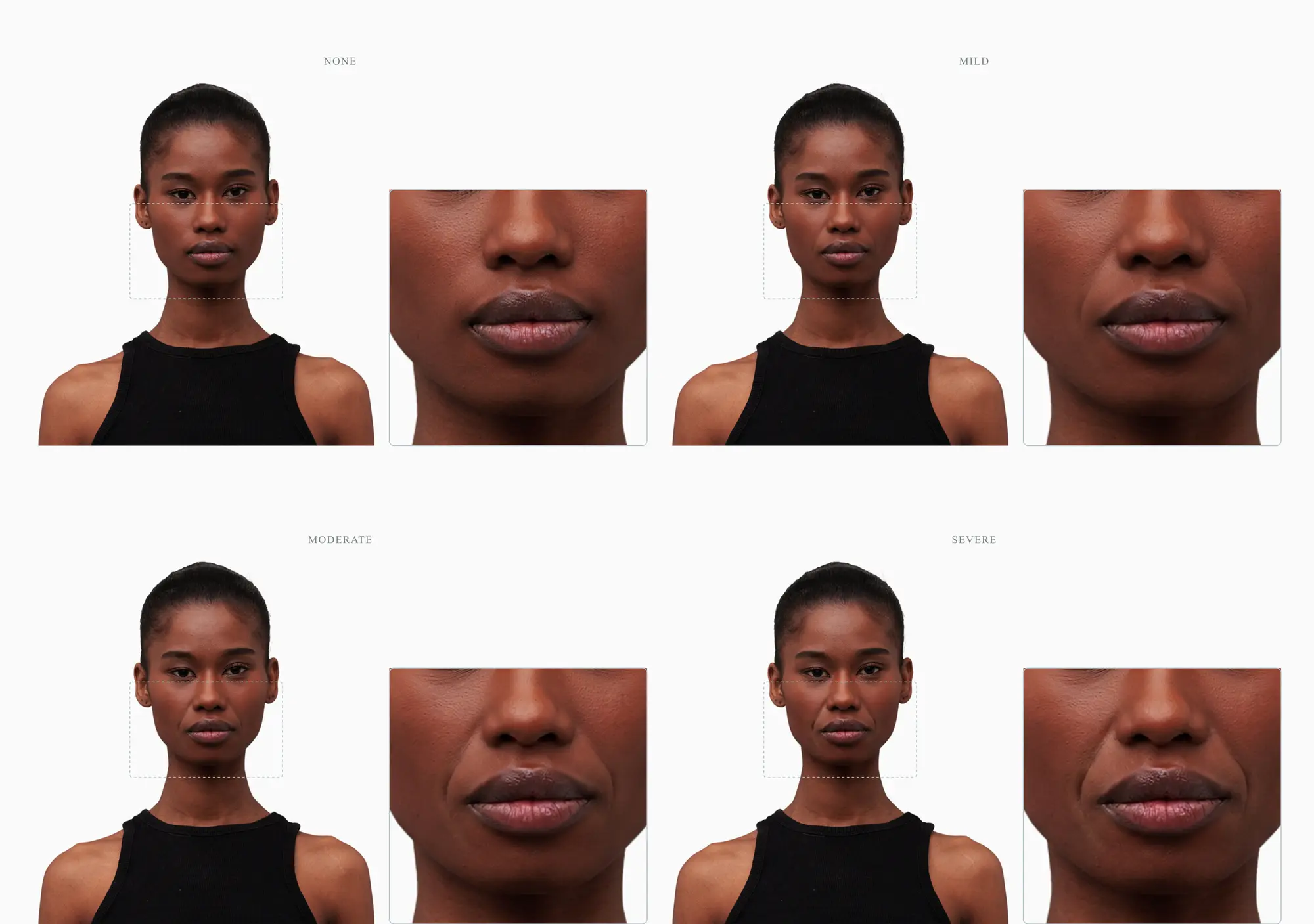 Nasolabial fold severity progression on a single face — none, mild, moderate, severe