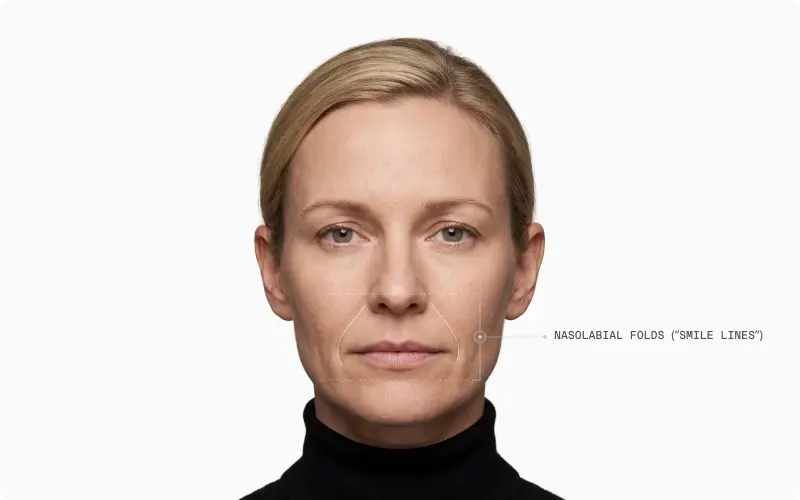 Front portrait of a woman with the right nasolabial fold called out