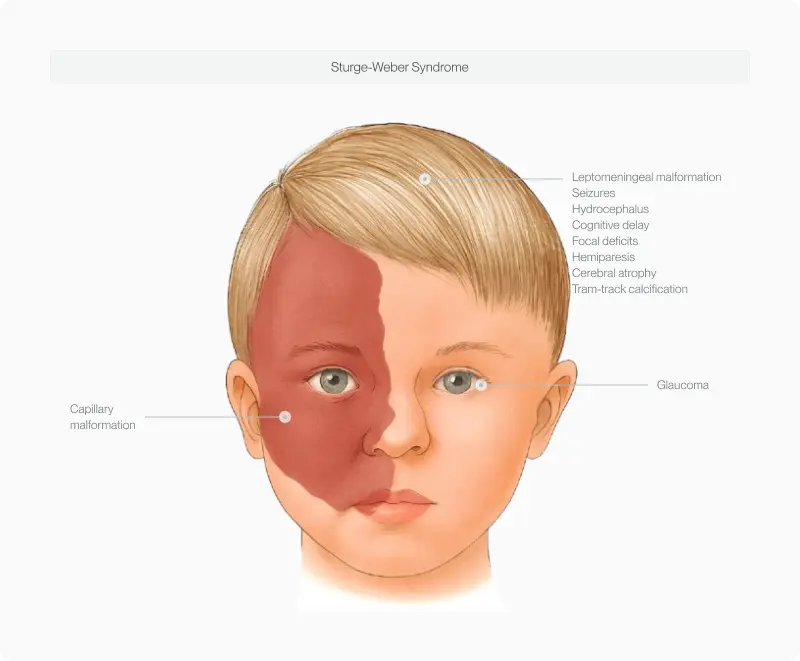 Child's face with Sturge-Weber syndrome callouts on one side, illustrating clinical deviation from averageness