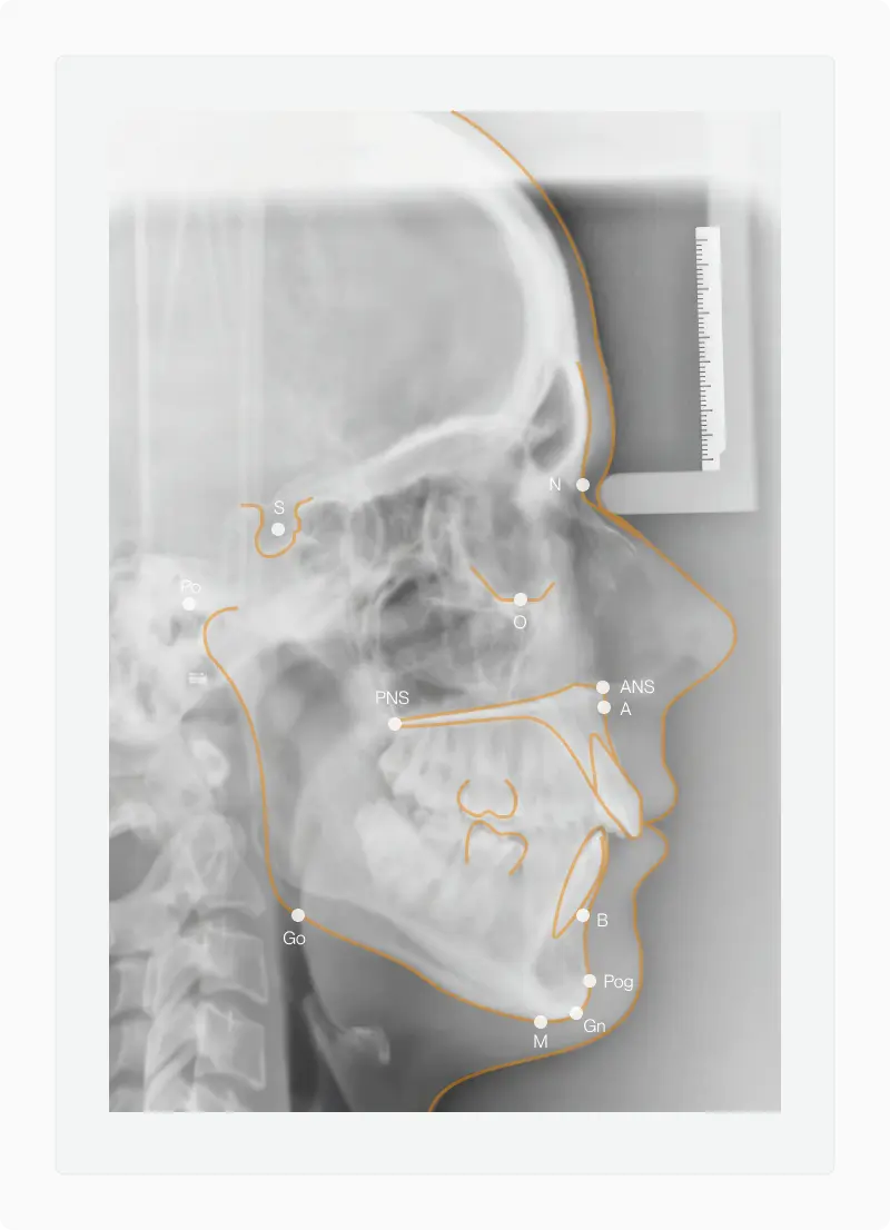 Lateral cephalogram x-ray of a skull with cephalometric landmarks and reference lines marked