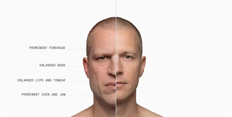 Front portrait of a man with acromegaly features called out (prominent forehead, enlarged nose, lips, tongue, chin and jaw)